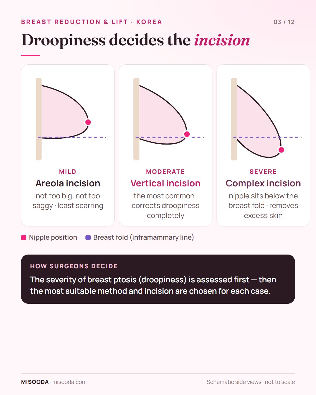 Breast ptosis levels and matching incision: mild droop areola incision, moderate vertical incision, severe droop with nipple below the fold complex incision