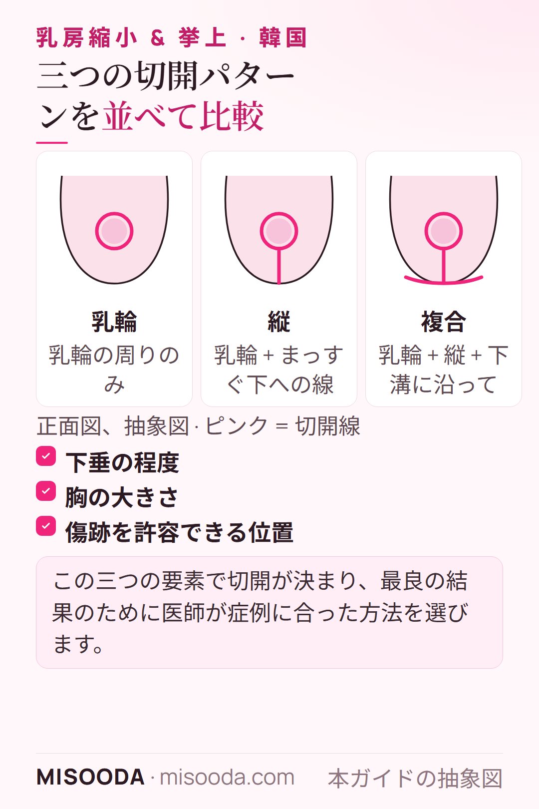 韓国 乳房縮小・挙上術の切開パターン:乳輪切開、縦切開、乳房下溝に沿った複合切開
