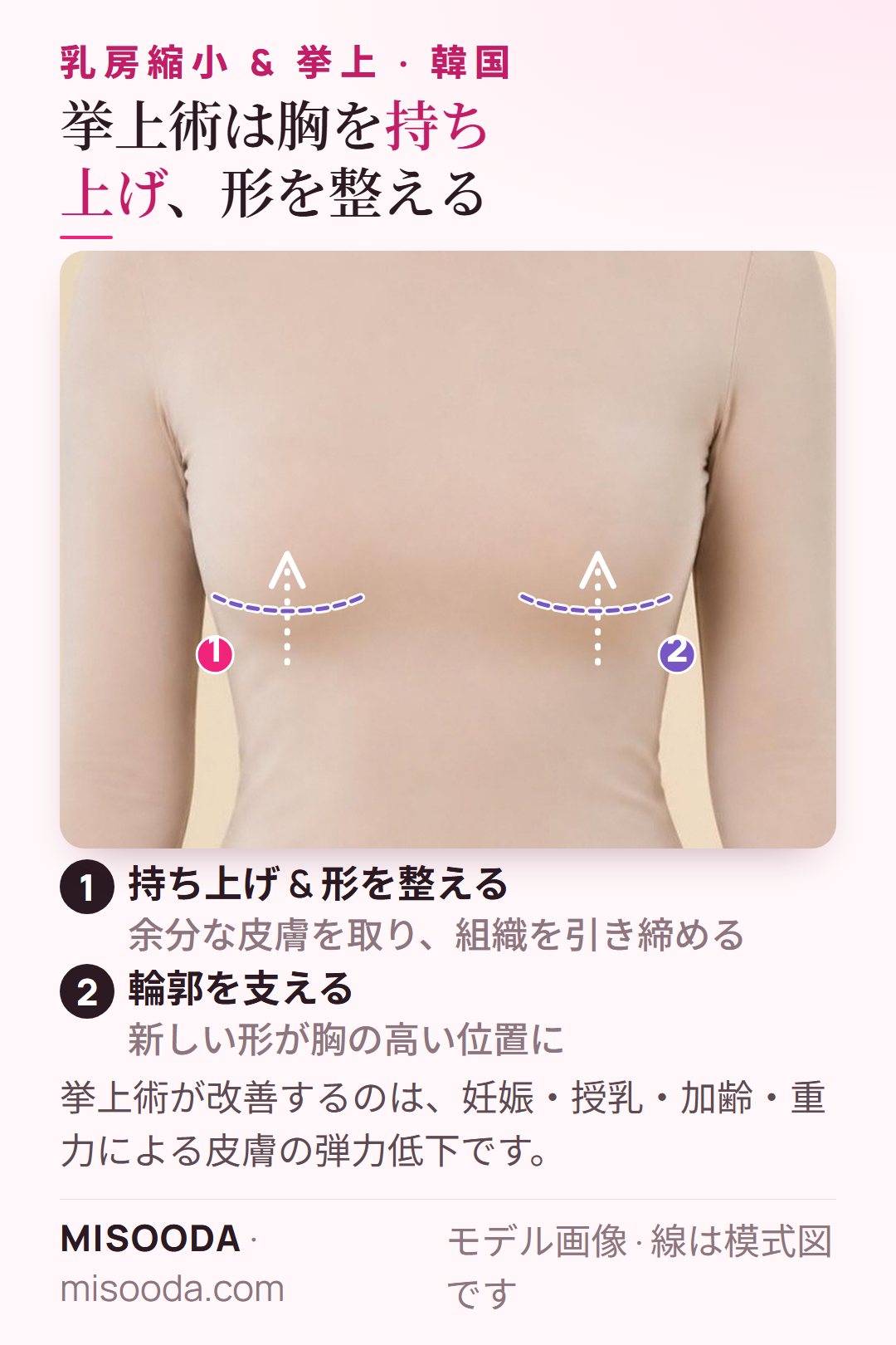 乳房挙上術(マストペクシー)を着衣のモデルで模式的に図示:余分な皮膚を取り、胸を乳房下溝より上に持ち上げます