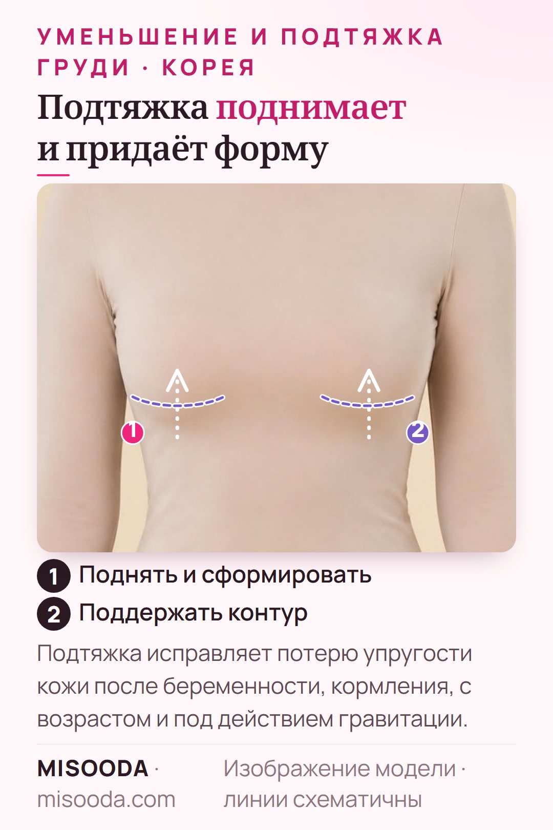 Подтяжка груди (мастопексия) схематично на модели в одежде: грудь поднята выше субмаммарной складки после удаления лишней кожи