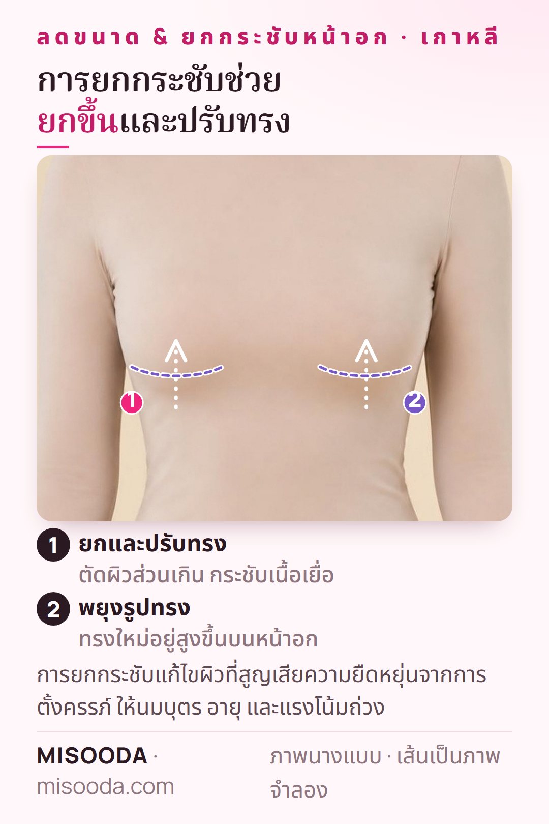 ยกกระชับหน้าอก (mastopexy) แสดงแบบจำลองบนนางแบบที่สวมเสื้อผ้า: หน้าอกยกสูงเหนือฐานราวนมหลังตัดผิวส่วนเกิน