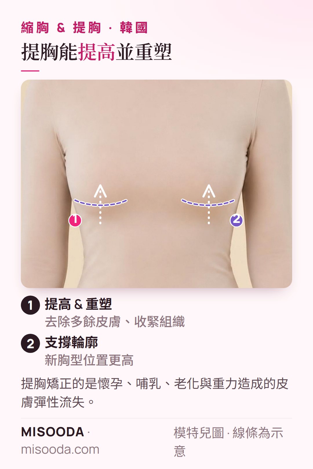 韓國 提胸(乳房上提術)著衣模特兒示意:去除多餘皮膚並收緊組織後,下垂胸部提高至乳房下緣上方