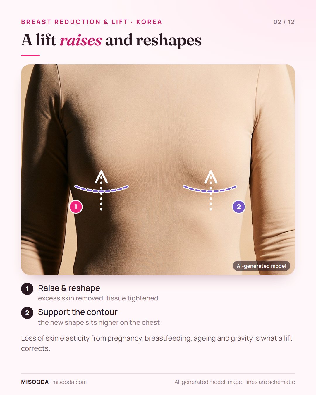 Breast lift (mastopexy) shown schematically on a clothed model: breasts raised above the breast fold after excess skin is removed