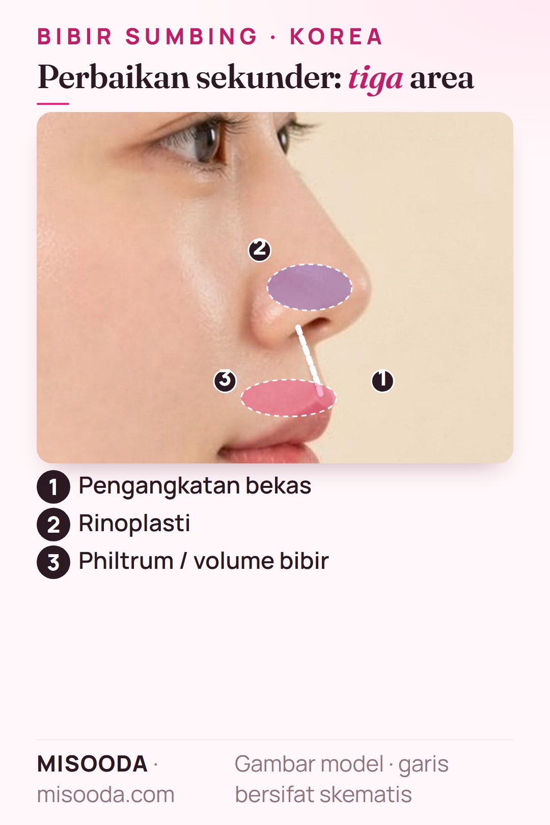 Area operasi sekunder bibir sumbing pada profil samping: pengangkatan bekas bibir dengan jahit ulang otot, rinoplasti untuk hidung sumbing, cangkok tulang atau jaringan philtrum