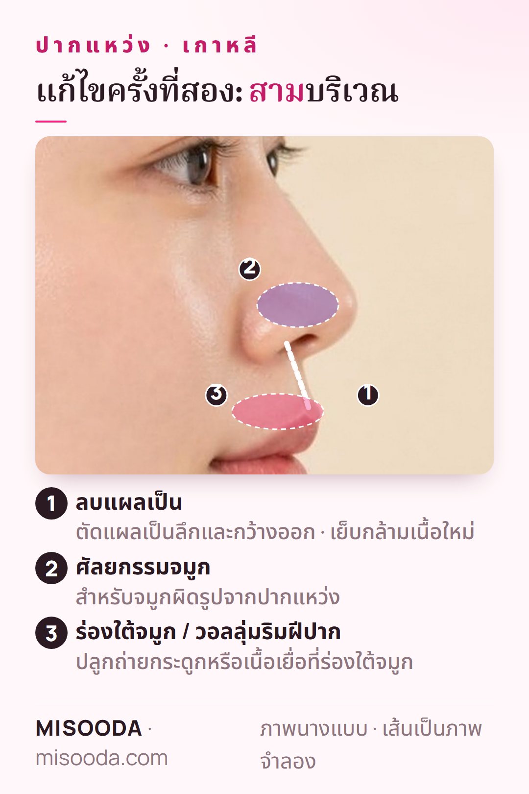 บริเวณผ่าตัดแก้ไขปากแหว่งครั้งที่สองบนภาพด้านข้าง: ลบแผลเป็นที่ริมฝีปากพร้อมเย็บกล้ามเนื้อใหม่ ศัลยกรรมจมูก ปลูกถ่ายกระดูกหรือเนื้อเยื่อร่องใต้จมูก