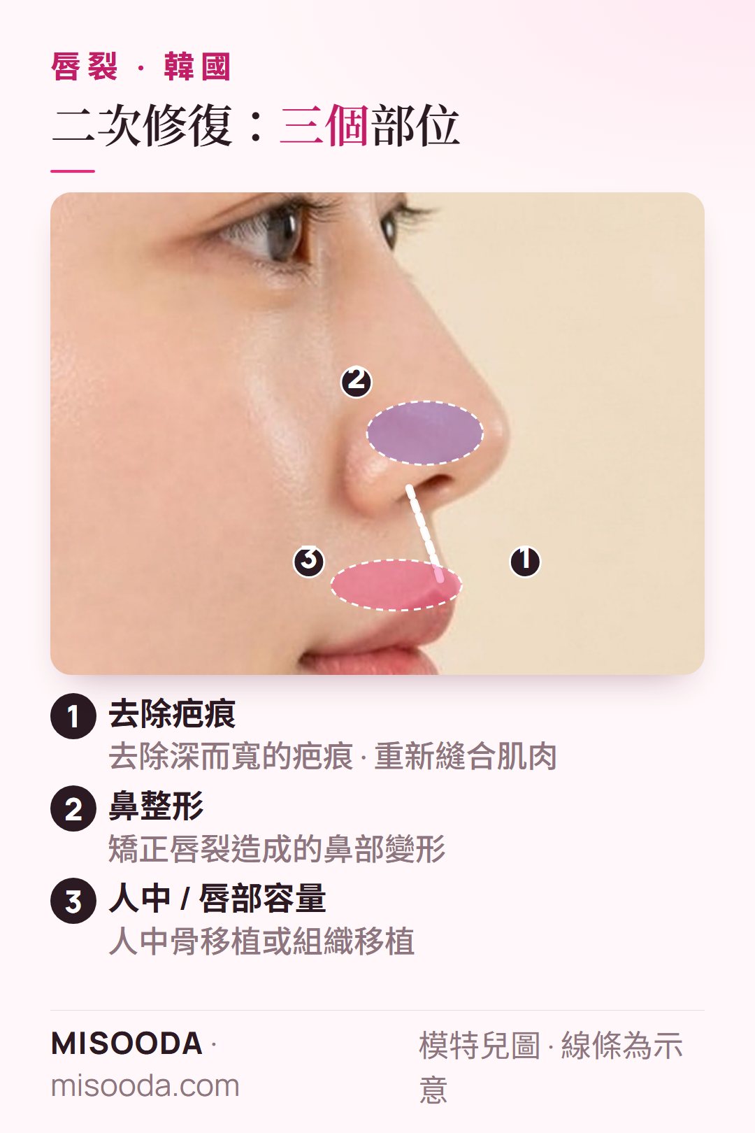 韓國 唇裂二次手術部位側臉示意:去除唇部疤痕並重新縫合肌肉、鼻整形矯正唇裂鼻變形、人中骨或組織移植