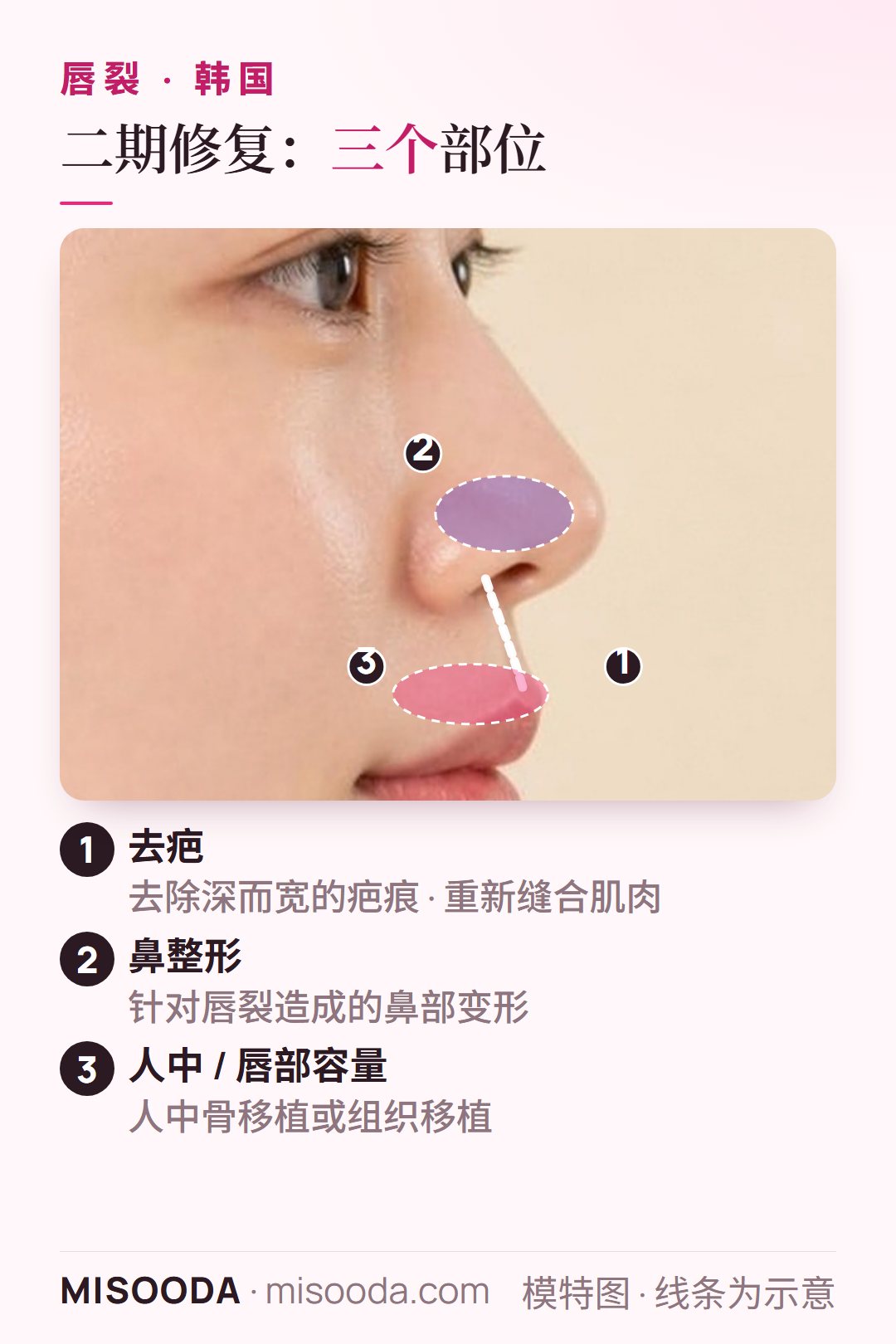 韩国 唇裂二期手术部位侧脸图:唇部去疤并重新缝合肌肉,针对唇裂鼻畸形做鼻整形,人中骨或组织移植