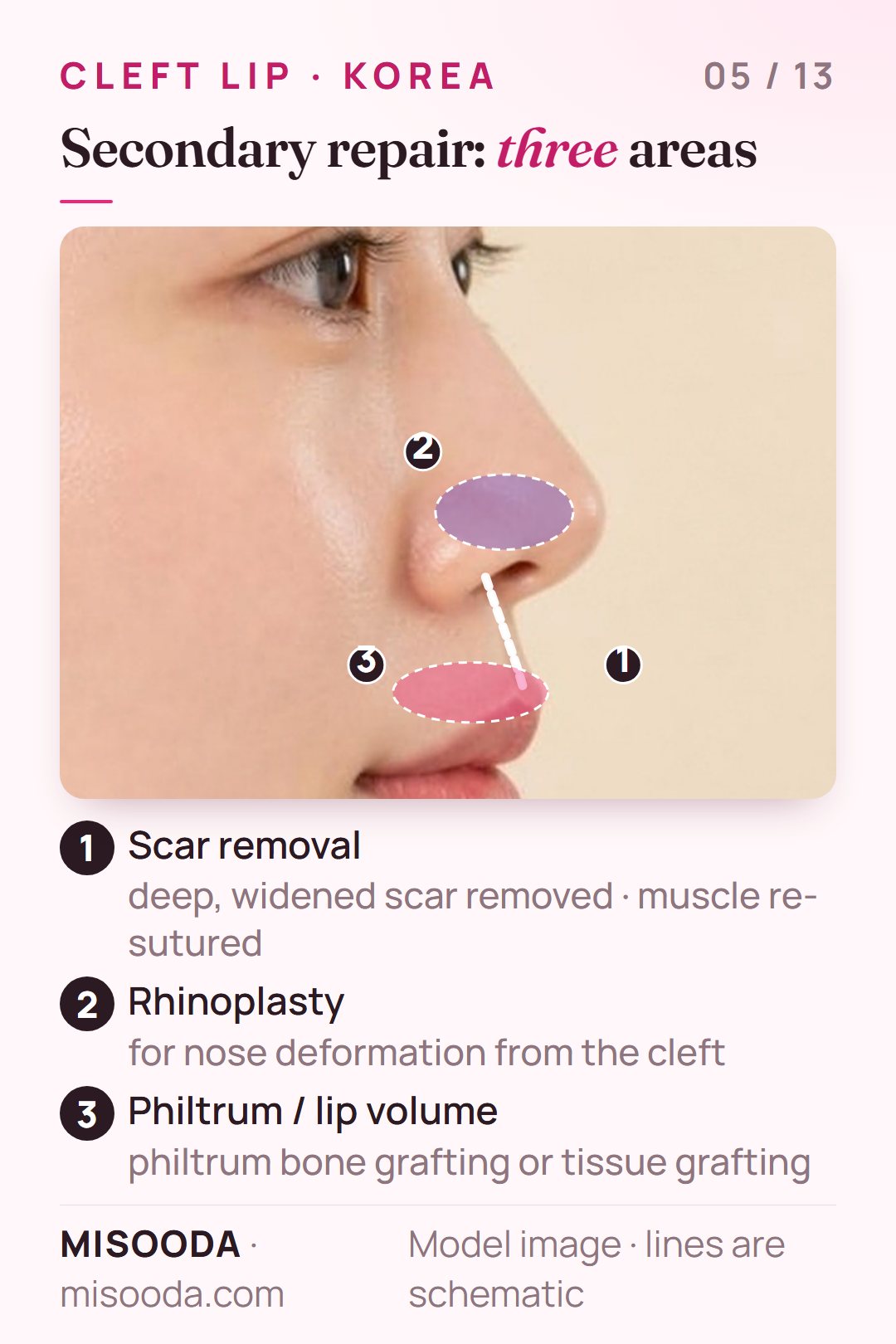 Secondary cleft lip surgery areas on a side profile: lip scar removal with muscle re-suturing, rhinoplasty for cleft nose deformation, philtrum bone or tissue grafting