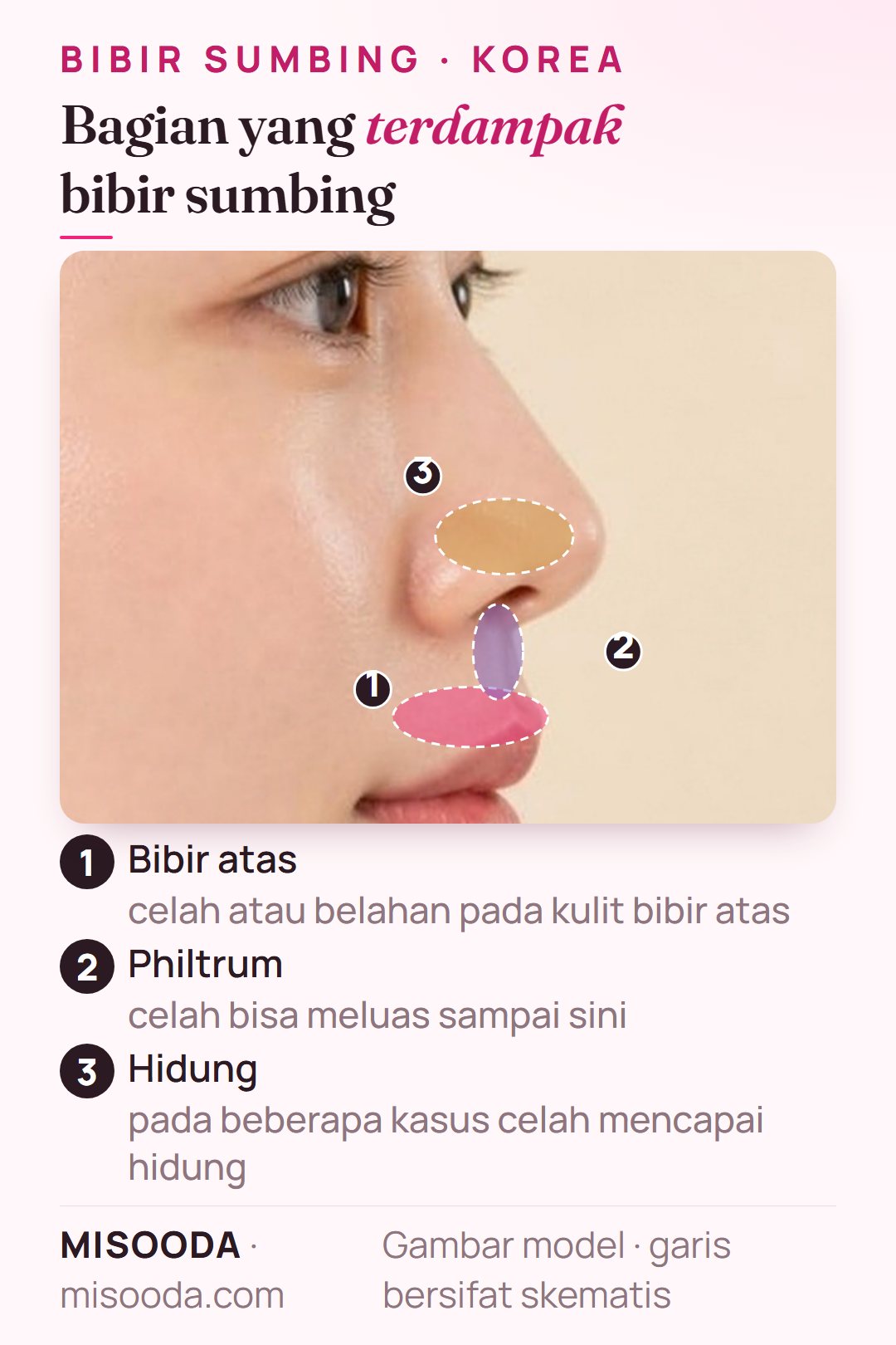 Bibir sumbing dijelaskan pada profil samping: celah di bibir atas yang bisa meluas ke philtrum dan hidung, area yang diperbaiki operasi bibir sumbing di Korea