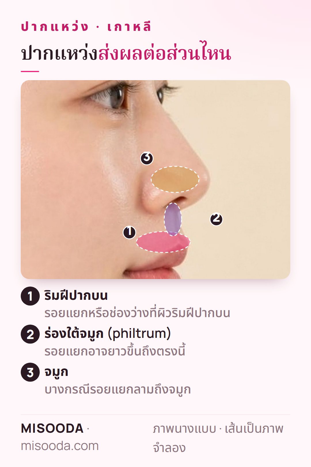 ปากแหว่ง ผ่าตัดเกาหลี อธิบายบนภาพด้านข้าง: รอยแยกที่ริมฝีปากบนซึ่งอาจยาวถึงร่องใต้จมูกและเข้าไปในจมูก บริเวณที่การผ่าตัดแก้ไข