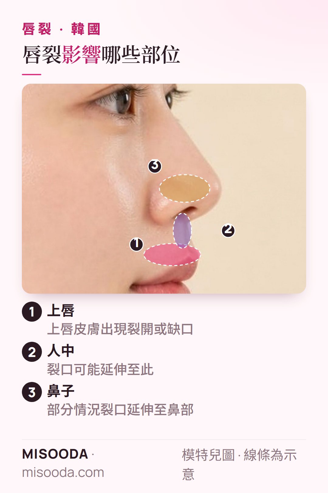 韓國 唇裂手術側臉示意:上唇裂開可能延伸至人中與鼻部,這些都是韓國唇裂手術修復的部位