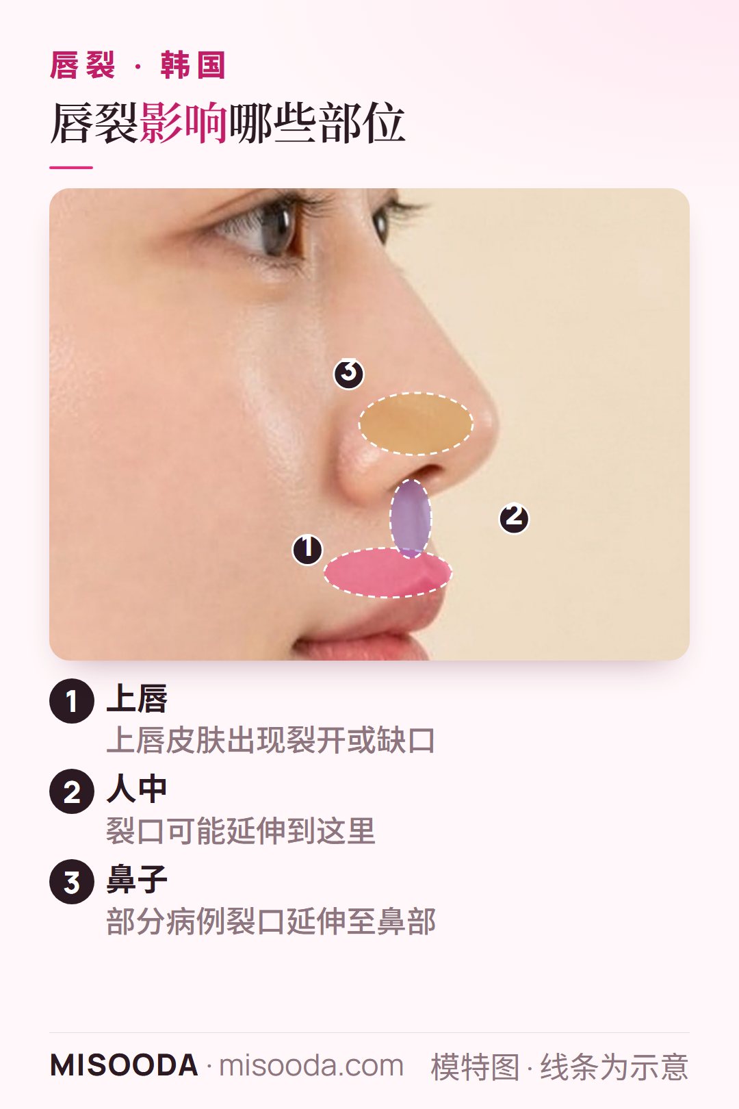 韩国 唇裂手术侧脸图解:上唇裂开,可能延伸至人中和鼻部,这些都是韩国唇裂修复的部位