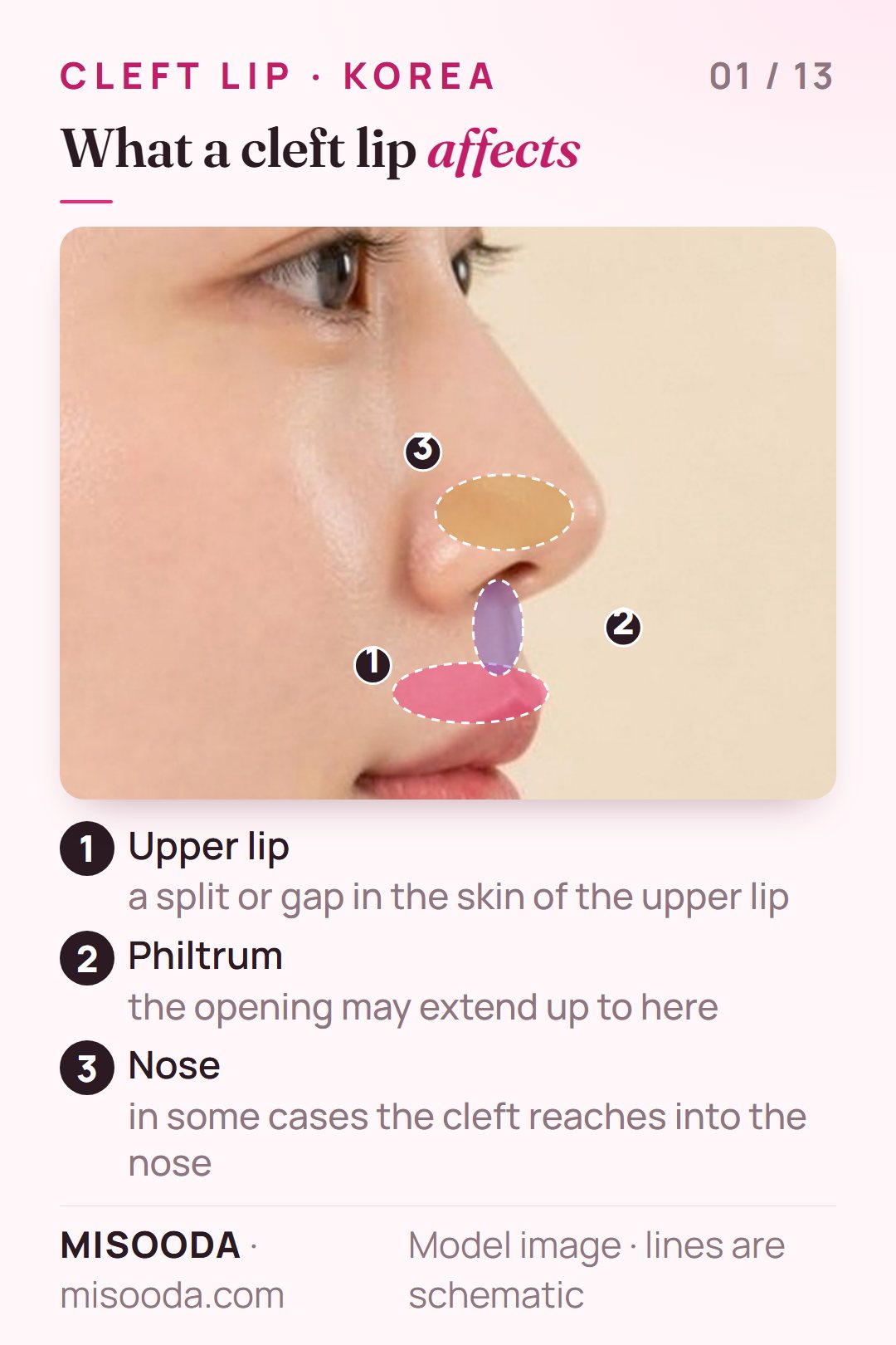 Cleft lip explained on a side profile: a split in the upper lip that may extend to the philtrum and into the nose, the areas cleft lip surgery in Korea repairs