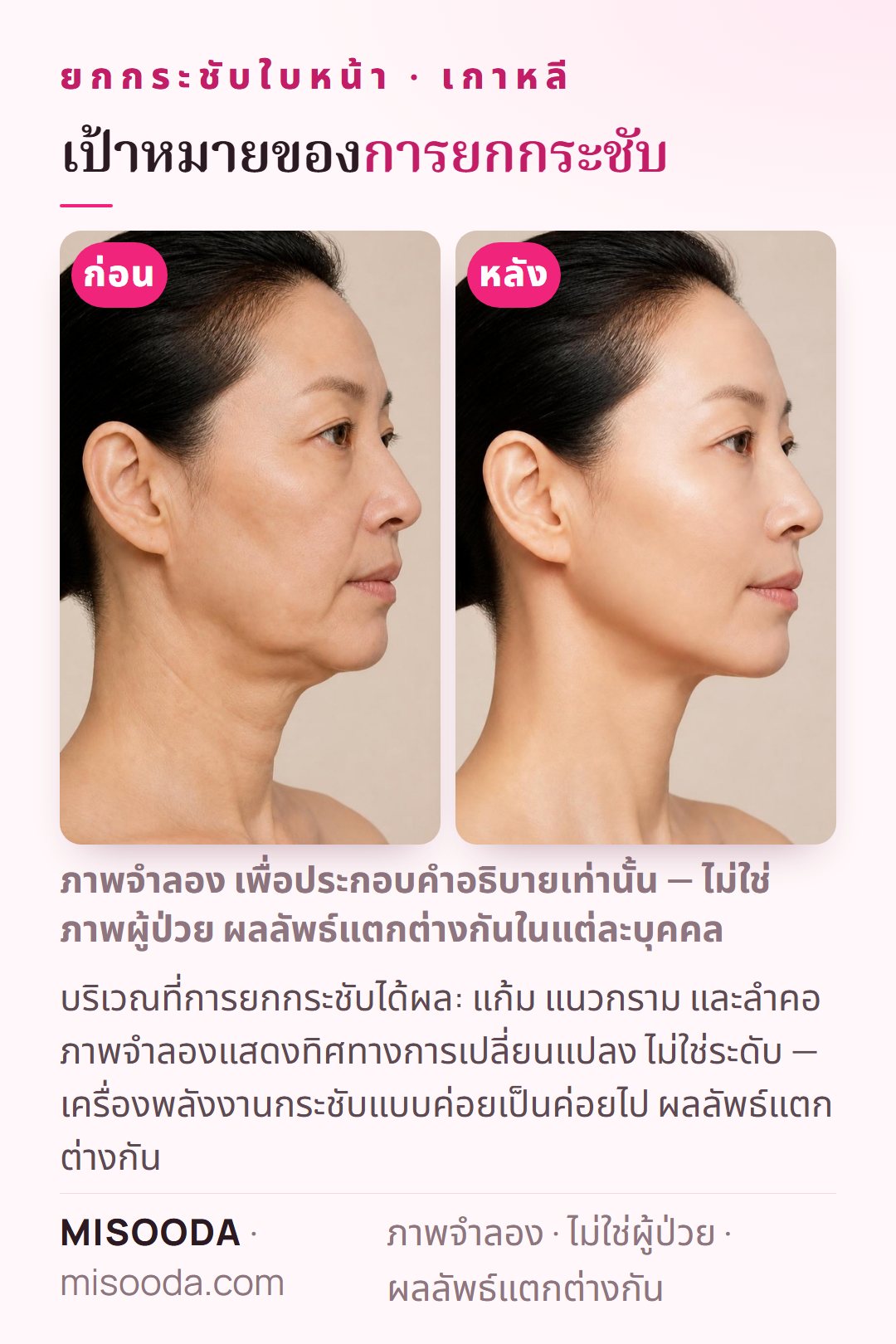 ภาพประกอบเป้าหมายทั่วไปของการยกกระชับใบหน้าที่เกาหลี — แก้ม แนวกราม และลำคอกระชับขึ้น — จำลองบนนางแบบ ไม่ใช่ผู้ป่วย แสดงเฉพาะทิศทางการเปลี่ยนแปลง