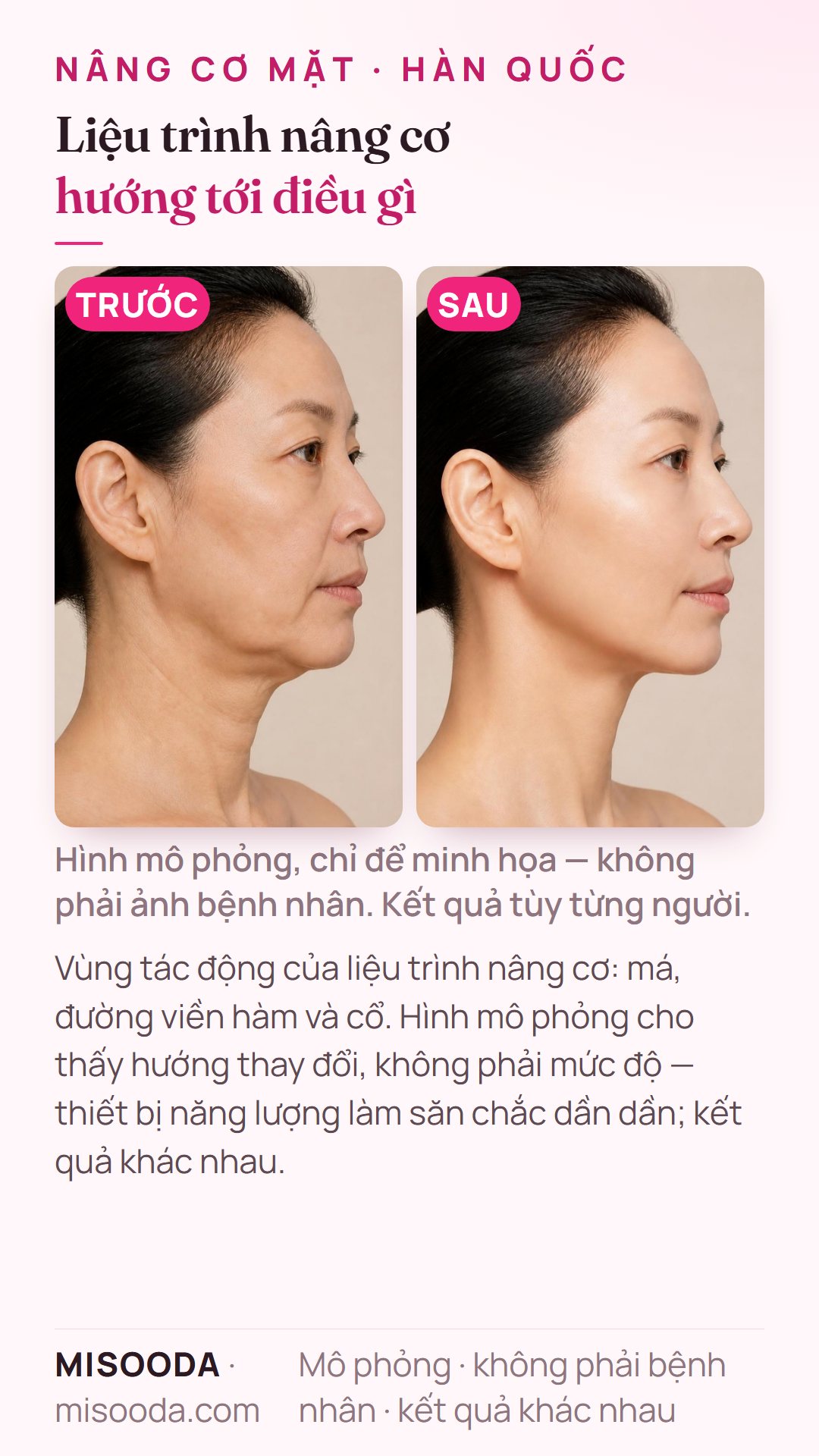 Minh họa mục tiêu thường gặp của liệu trình nâng cơ mặt tại Hàn Quốc — má, đường viền hàm và cổ săn chắc hơn — mô phỏng trên người mẫu, không phải bệnh nhân; chỉ thể hiện hướng thay đổi
