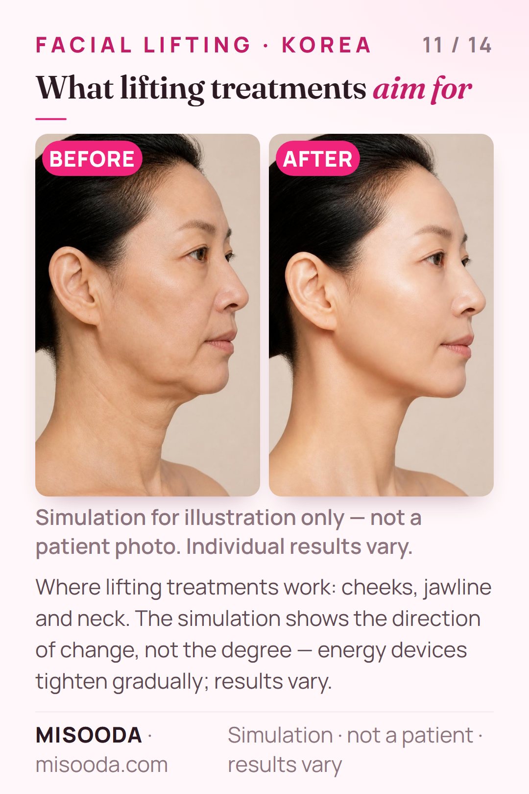Illustration of the typical goals of facial lifting treatments in Korea — firmer cheeks, jawline and neck — simulated on a model, not a patient; direction of change only