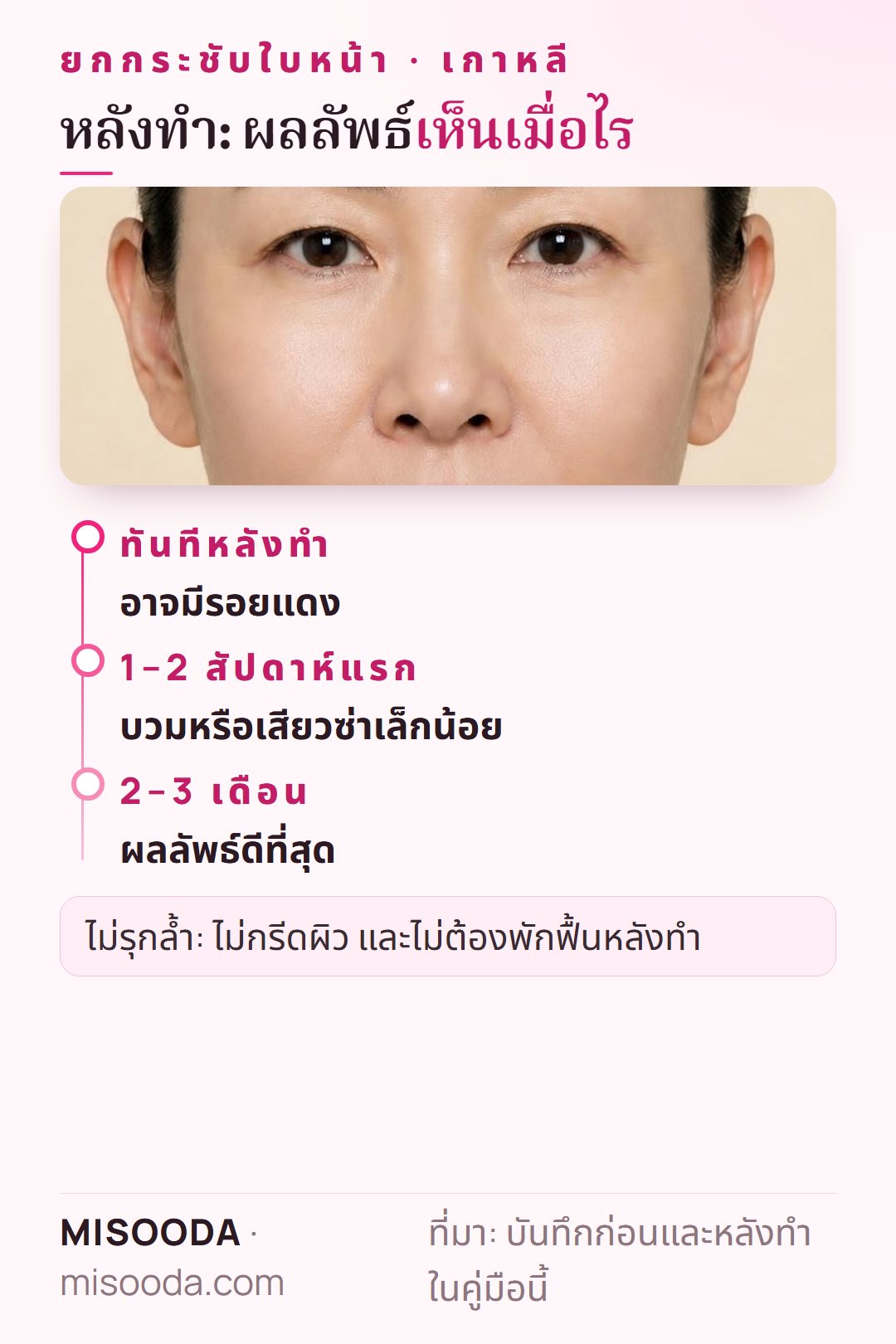 ไทม์ไลน์ผลยกกระชับใบหน้า: รอยแดงหายในไม่กี่ชั่วโมง บวมหรือเสียวซ่าเล็กน้อยหายใน 1–2 สัปดาห์ ผลดีที่สุดที่ 2–3 เดือนเมื่อคอลลาเจนก่อตัว