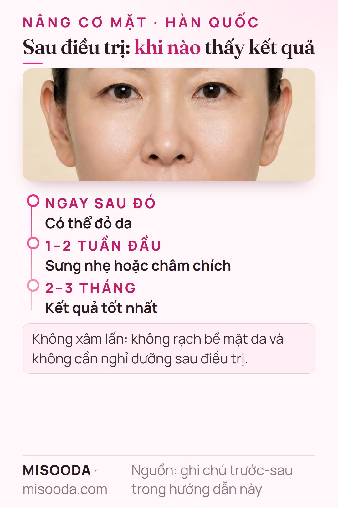 Lộ trình kết quả nâng cơ mặt: đỏ da hết sau vài giờ, sưng nhẹ hoặc châm chích dịu trong 1–2 tuần, kết quả tốt nhất sau 2–3 tháng khi collagen hình thành