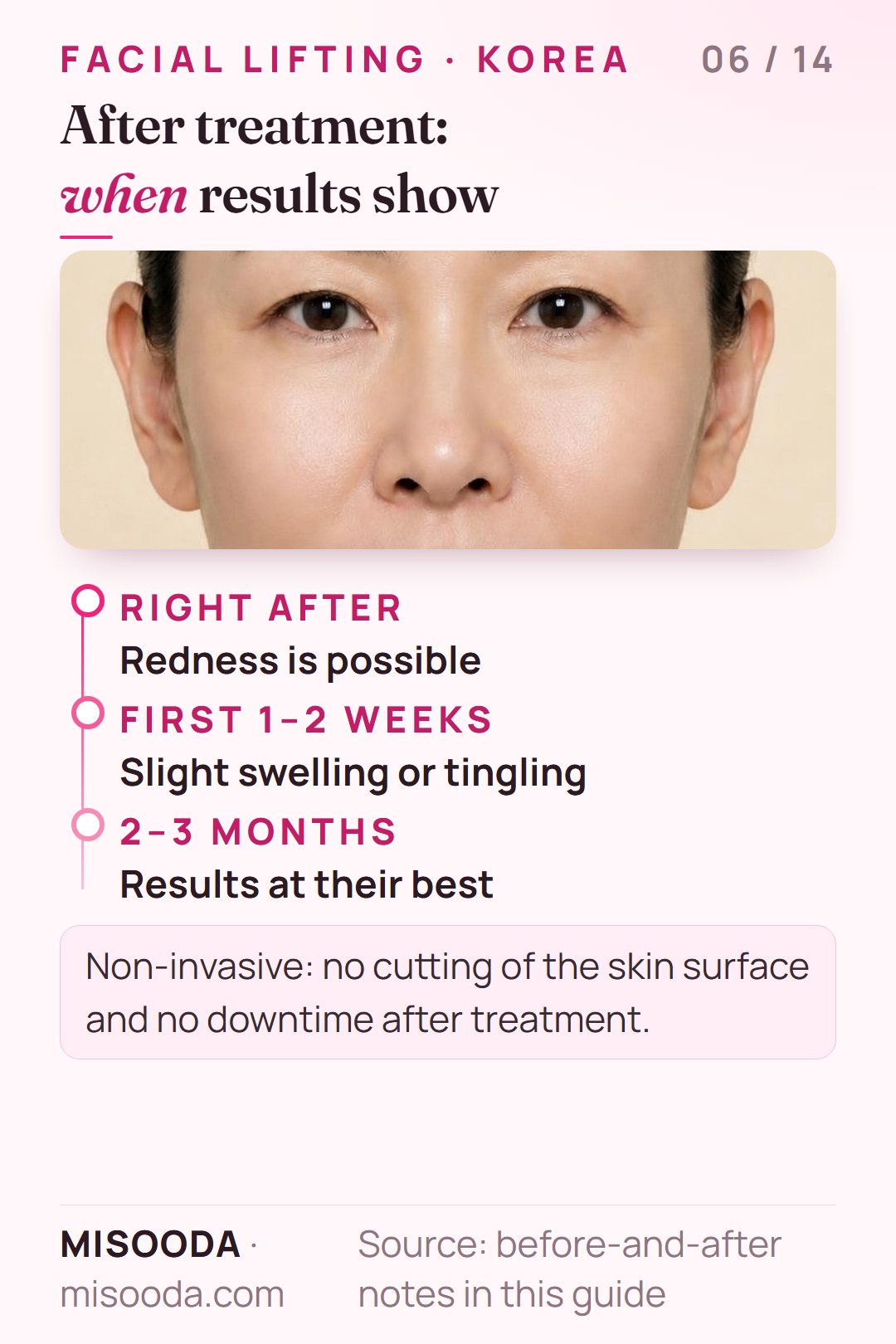 Facial lifting results timeline: redness fades in a few hours, slight swelling or tingling settles in 1–2 weeks, best results at 2–3 months as collagen forms