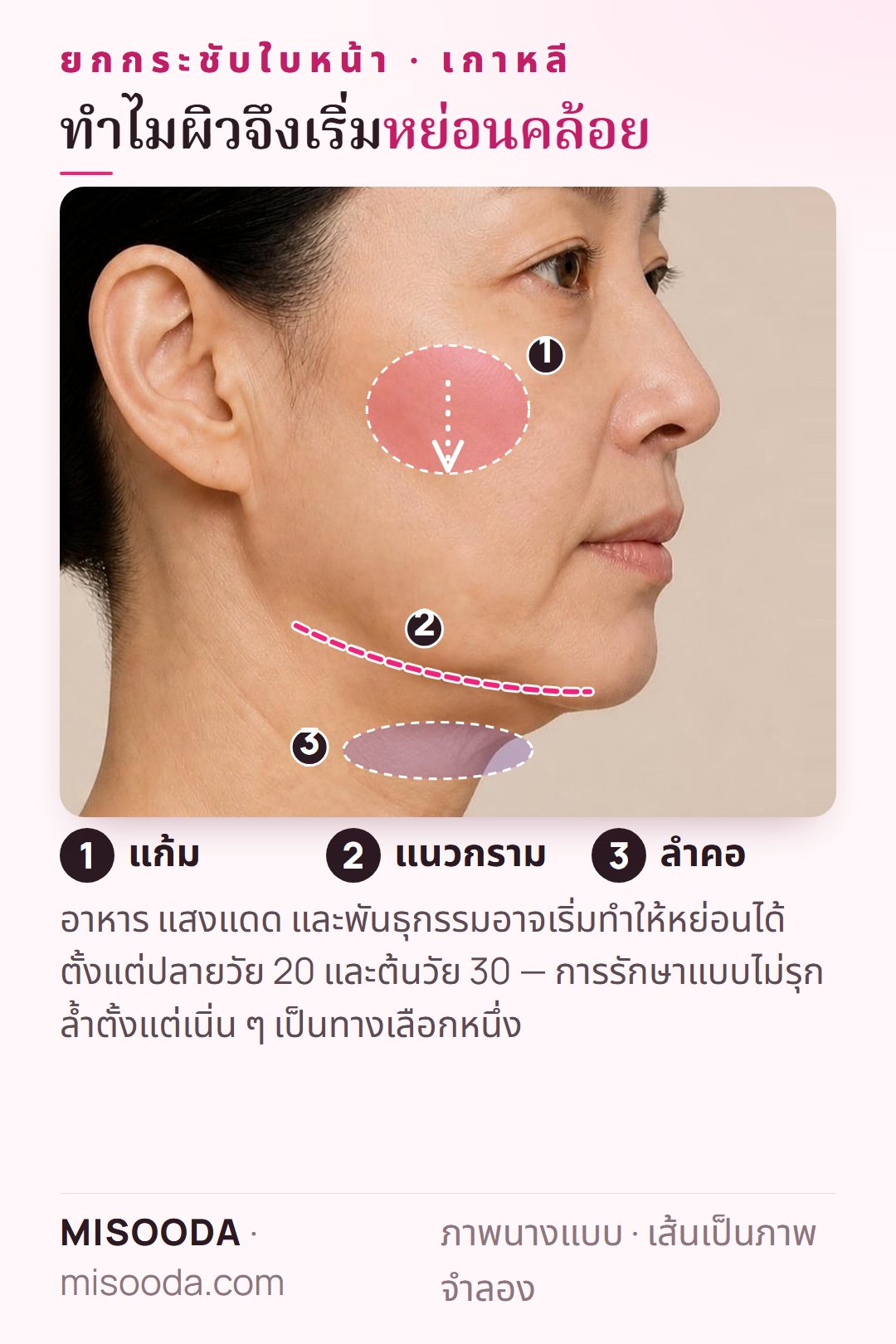 ยกกระชับใบหน้า เกาหลี: บริเวณที่ผิวหย่อนคล้อยที่แก้ม แนวกราม และลำคอ — การสูญเสียความยืดหยุ่นและคอลลาเจนอาจเริ่มตั้งแต่ปลายวัย 20 และต้นวัย 30