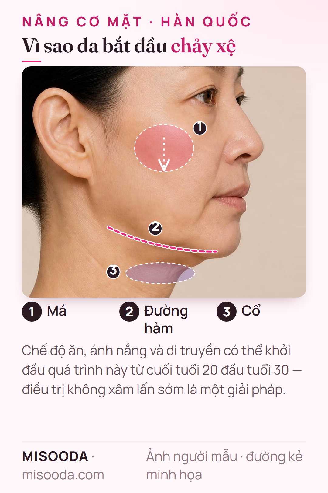 Nâng cơ mặt Hàn Quốc: vùng da chảy xệ ở má, đường hàm và cổ — mất đàn hồi và collagen có thể bắt đầu từ cuối tuổi 20 đầu tuổi 30