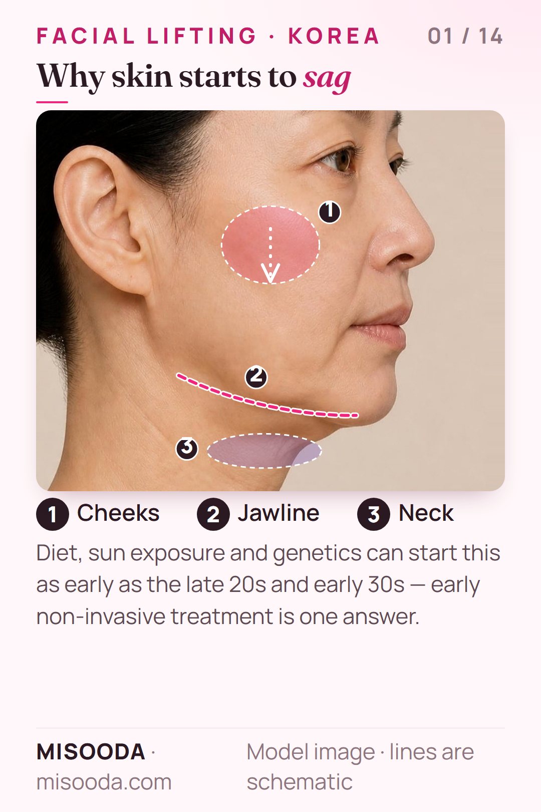 Facial lifting in Korea: where skin sags on the cheeks, jawline and neck — loss of elasticity and collagen can begin in the late 20s and early 30s