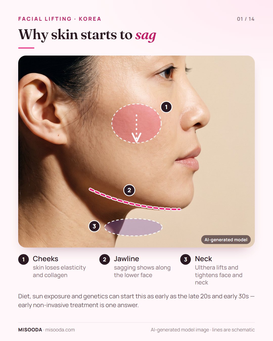 Facial lifting in Korea: where skin sags on the cheeks, jawline and neck — loss of elasticity and collagen can begin in the late 20s and early 30s