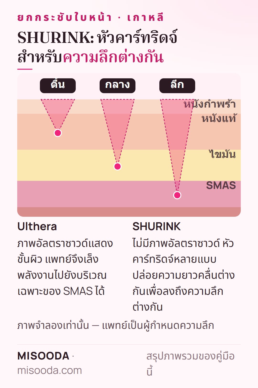 การเล็งของ SHURINK เทียบ Ulthera: หัวคาร์ทริดจ์ SHURINK ปล่อยความยาวคลื่นต่างกันเพื่อลงถึงชั้นตื้น กลาง และลึก ส่วน Ulthera ใช้ภาพอัลตราซาวด์