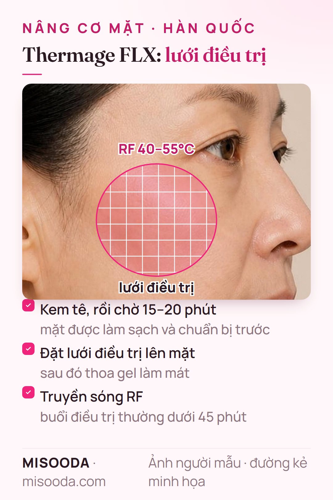 Điều trị Thermage FLX trên má: kem tê 15–20 phút, lưới điều trị và gel làm mát, rồi sóng RF ở 40–55°C trong dưới 45 phút