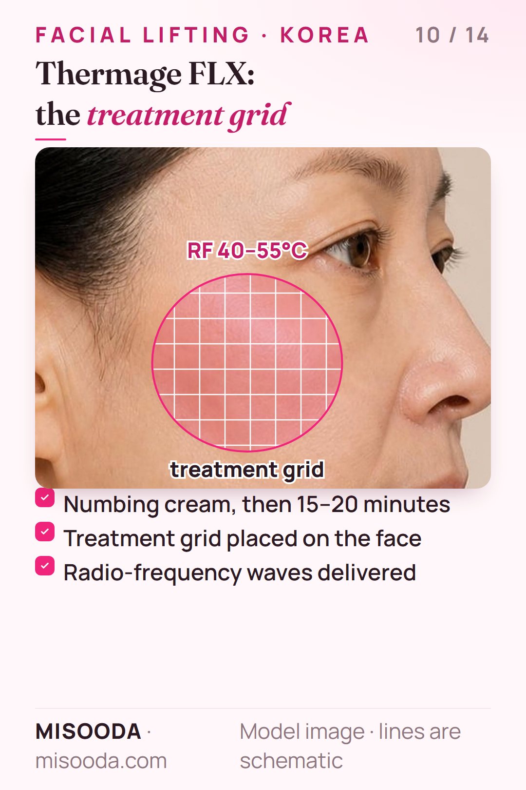 Thermage FLX treatment on the cheek: numbing cream for 15–20 minutes, a treatment grid and cooling gel, then radio frequency at 40–55°C in under 45 minutes