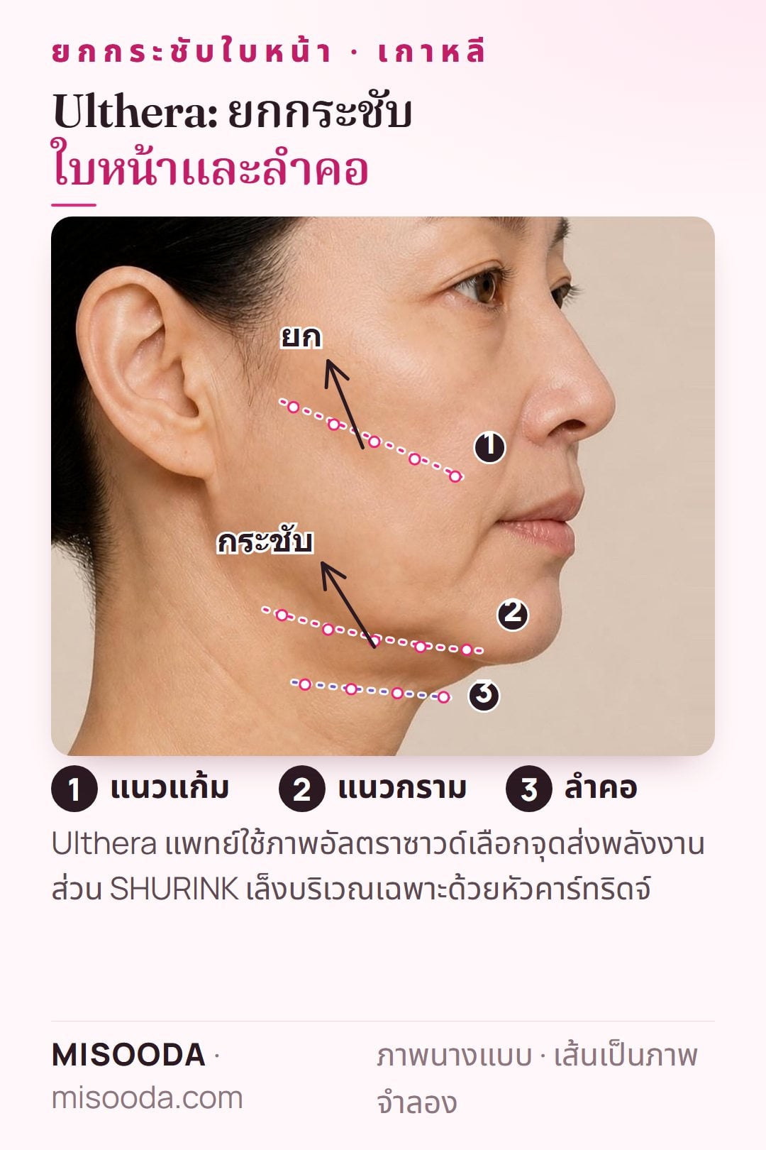 โซนยกกระชับ Ulthera HIFU บนภาพด้านข้าง: จุดอัลตราซาวด์โฟกัสตามแนวแก้ม แนวกราม และลำคอ เพื่อยกกระชับผิว