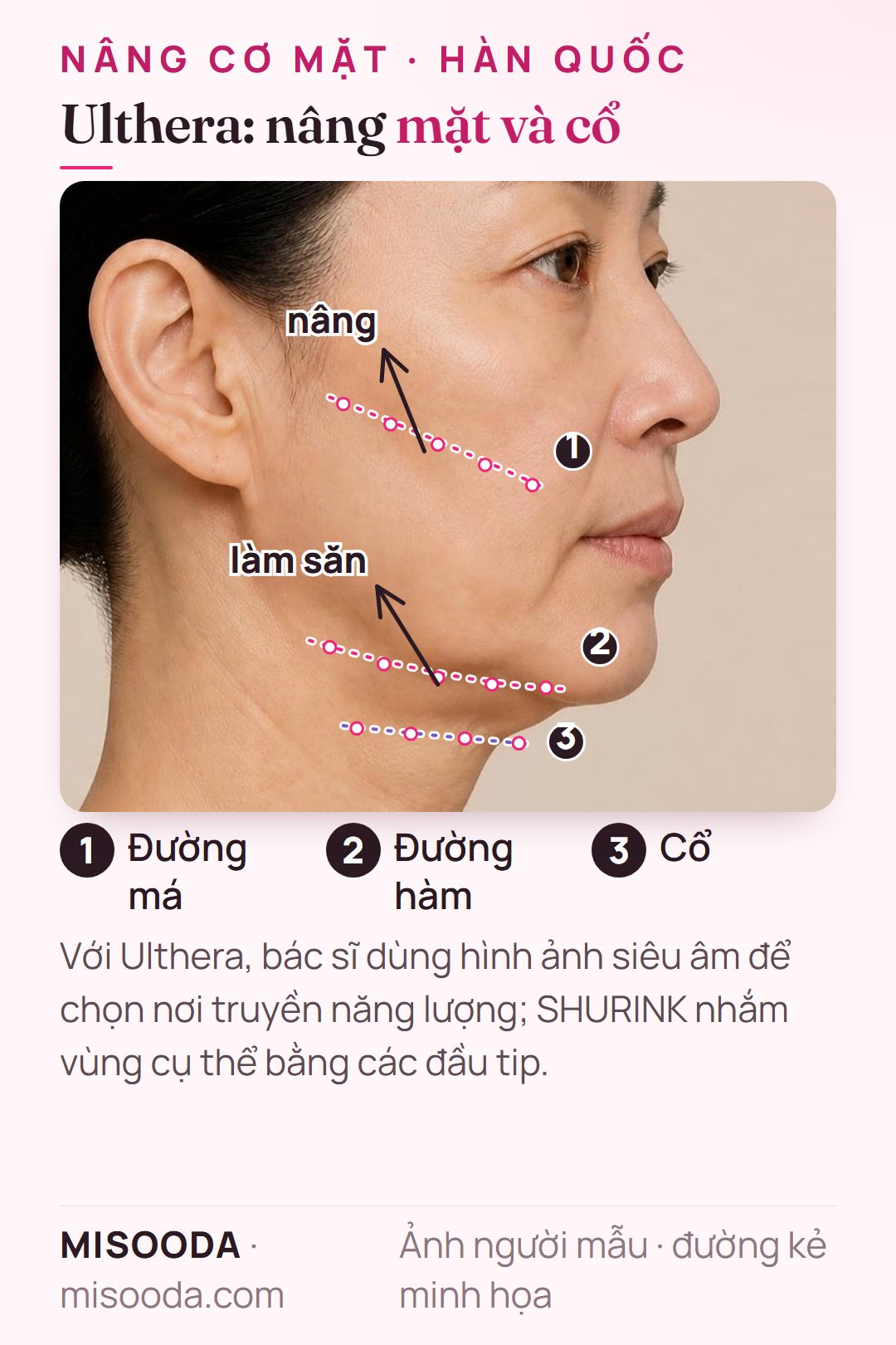 Vùng nâng cơ HIFU Ulthera trên dáng nghiêng: các điểm siêu âm hội tụ dọc đường má, đường hàm và cổ để nâng và làm săn da