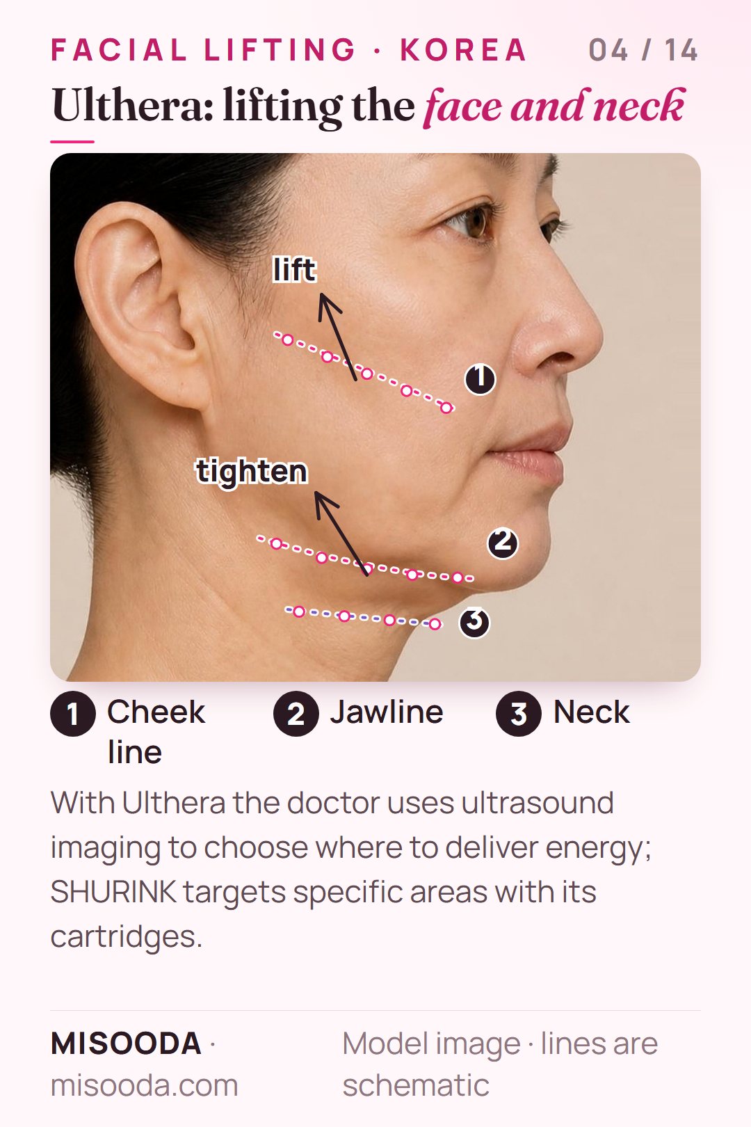 Ulthera HIFU facial lifting zones on a side profile: focused ultrasound points along the cheek line, jawline and neck to lift and tighten skin