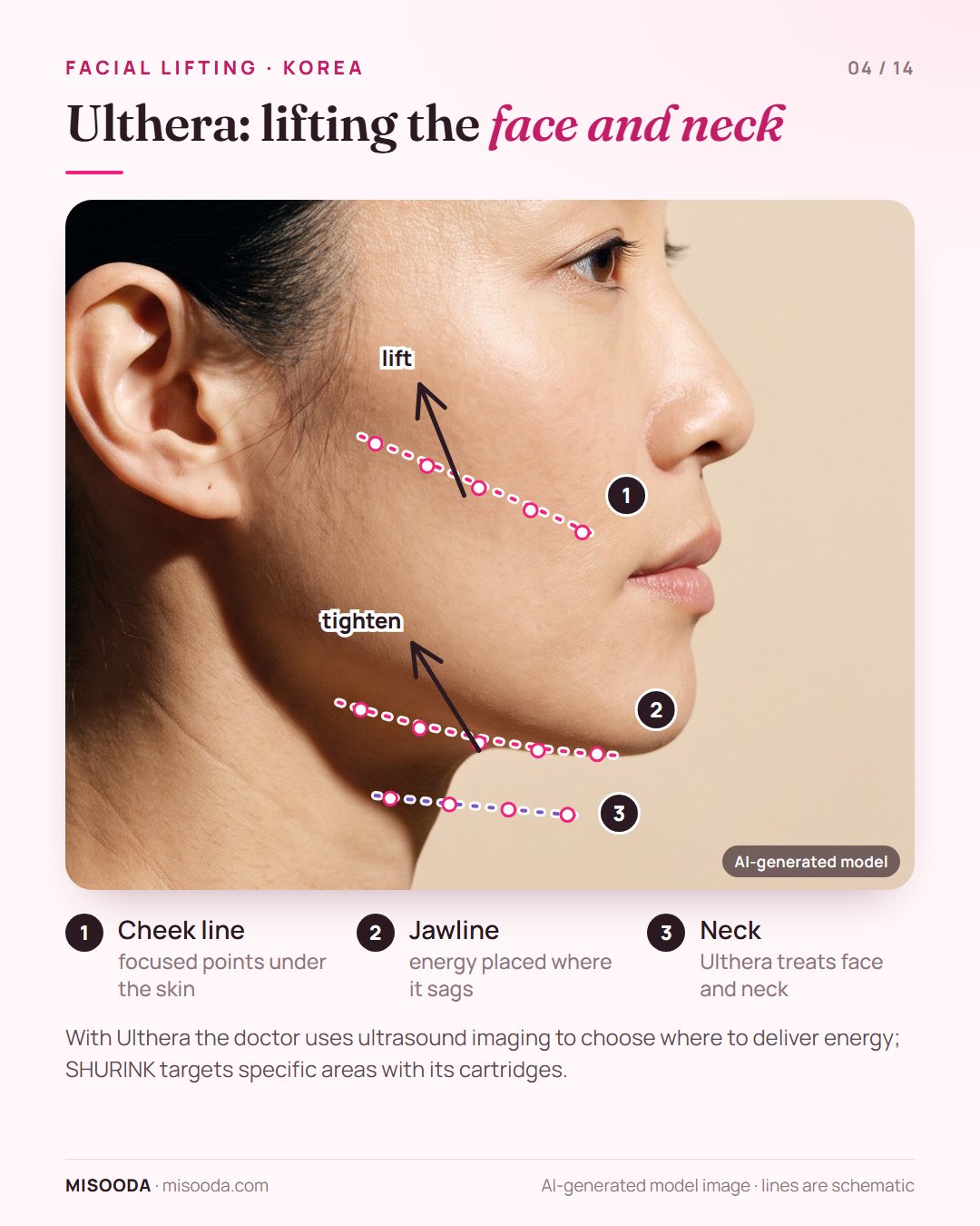 Ulthera HIFU facial lifting zones on a side profile: focused ultrasound points along the cheek line, jawline and neck to lift and tighten skin