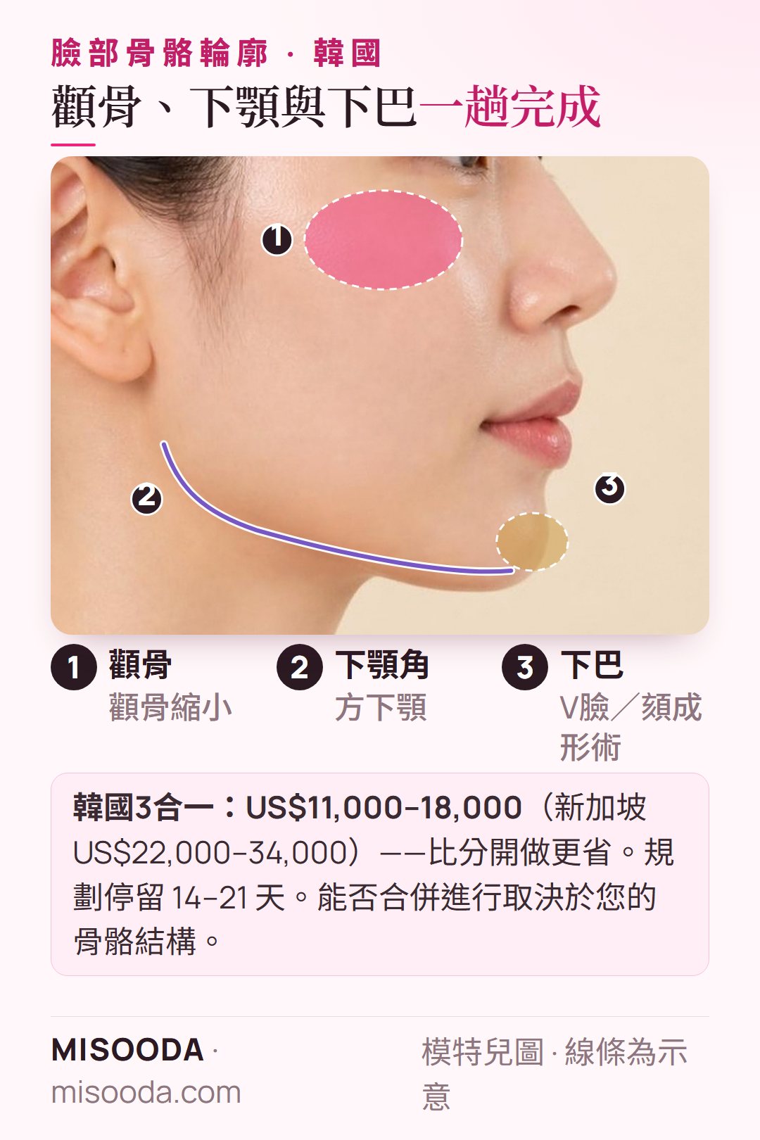 韓國 3合一臉部輪廓一趟完成:顴骨、下顎角與下巴一起做,韓國 US$11,000–18,000 vs 新加坡 US$22,000–34,000,停留 14–21 天
