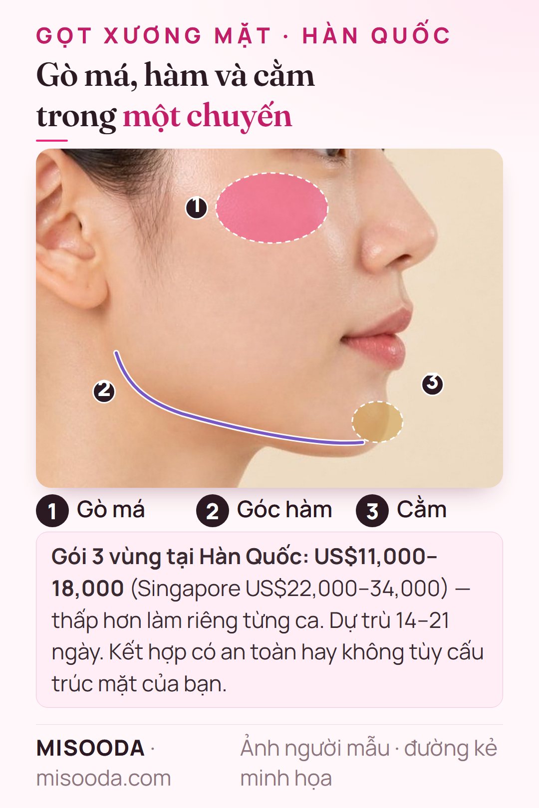 Gọt mặt 3 vùng trong một chuyến: gò má, góc hàm và cằm cùng lúc với US$11,000–18,000 tại Hàn Quốc so với US$22,000–34,000 tại Singapore, lưu trú 14–21 ngày
