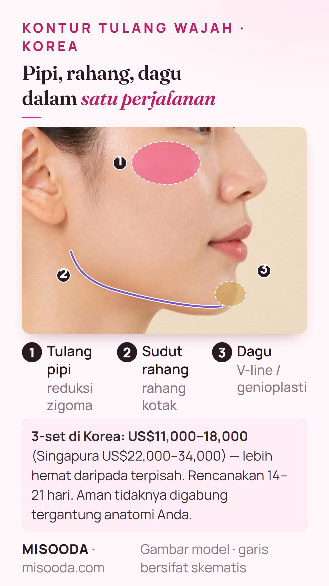 Kontur wajah 3-set di Korea dalam satu perjalanan: tulang pipi, sudut rahang dan dagu sekaligus US$11,000–18,000 vs US$22,000–34,000 di Singapura, tinggal 14–21 hari