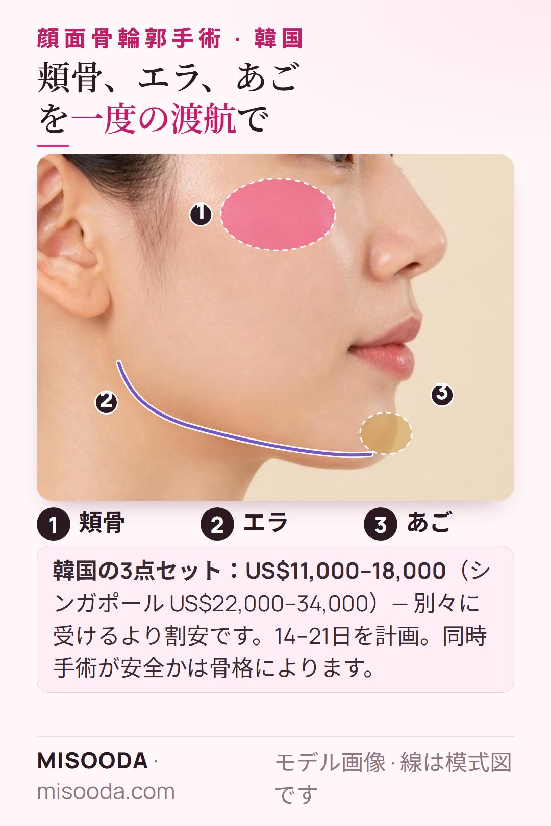 韓国 3点セット顔面輪郭手術を一度の渡航で:頬骨、エラ、あごを一緒に、韓国 US$11,000–18,000 対 シンガポール US$22,000–34,000、滞在14–21日