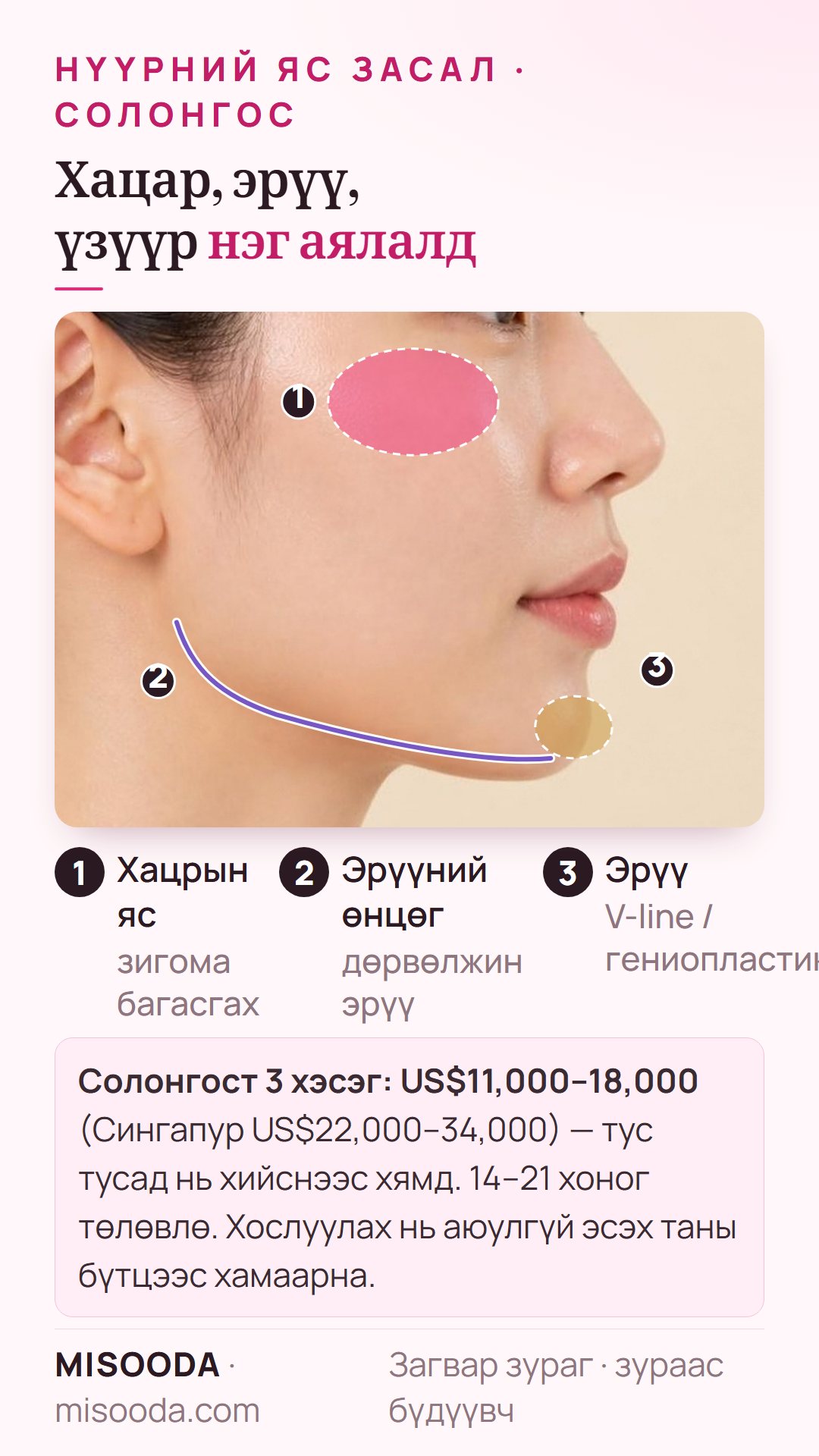 Нэг аялалд 3 хэсгийн нүүрний яс засал: хацрын яс, эрүүний өнцөг, эрүү хамт Солонгост US$11,000–18,000, Сингапурт US$22,000–34,000, 14–21 хоног байна