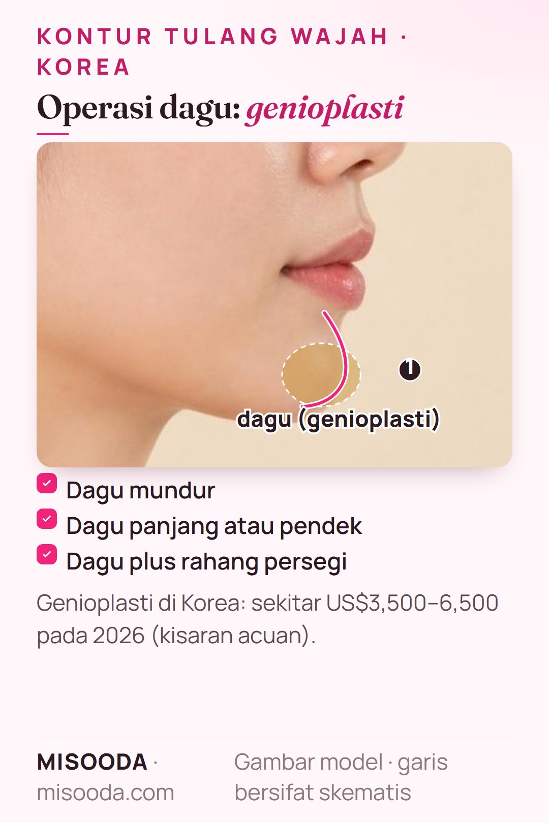 Zona genioplasti bentuk dagu di Korea pada profil samping untuk dagu mundur, panjang atau pendek — sekitar US$3,500–6,500 pada 2026