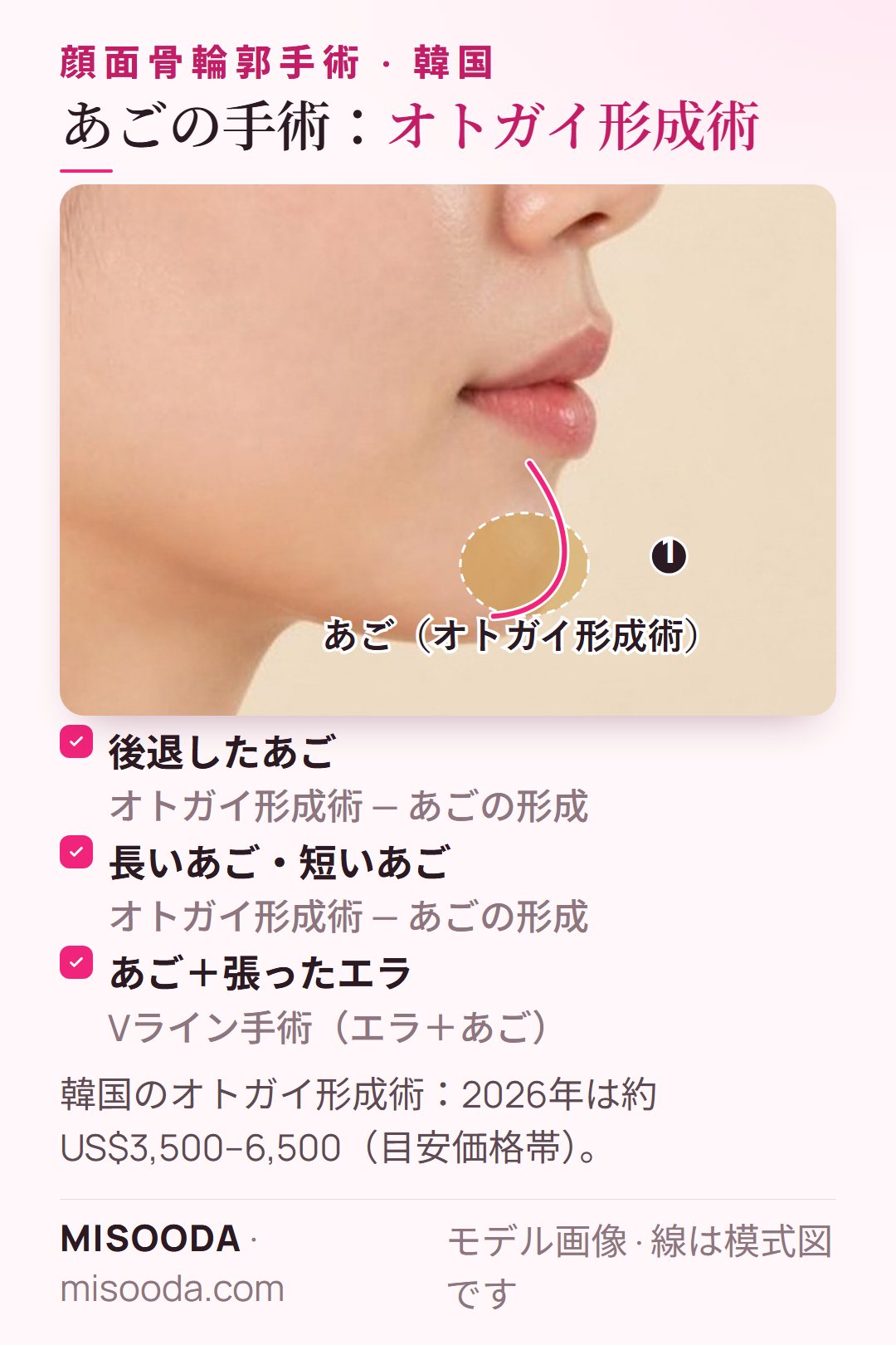 韓国 オトガイ形成術であごの形を整える部位を横顔で図示:後退したあご、長いあご、短いあご — 2026年は約US$3,500–6,500
