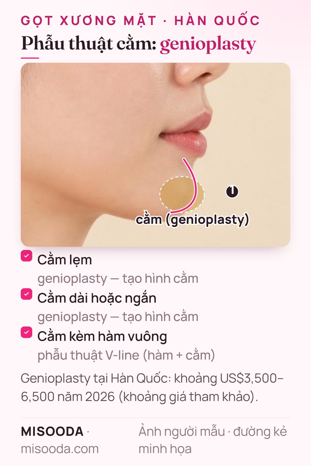 Vùng tạo hình cằm genioplasty trên góc nghiêng cho cằm lẹm, dài hoặc ngắn — khoảng US$3,500–6,500 tại Hàn Quốc năm 2026