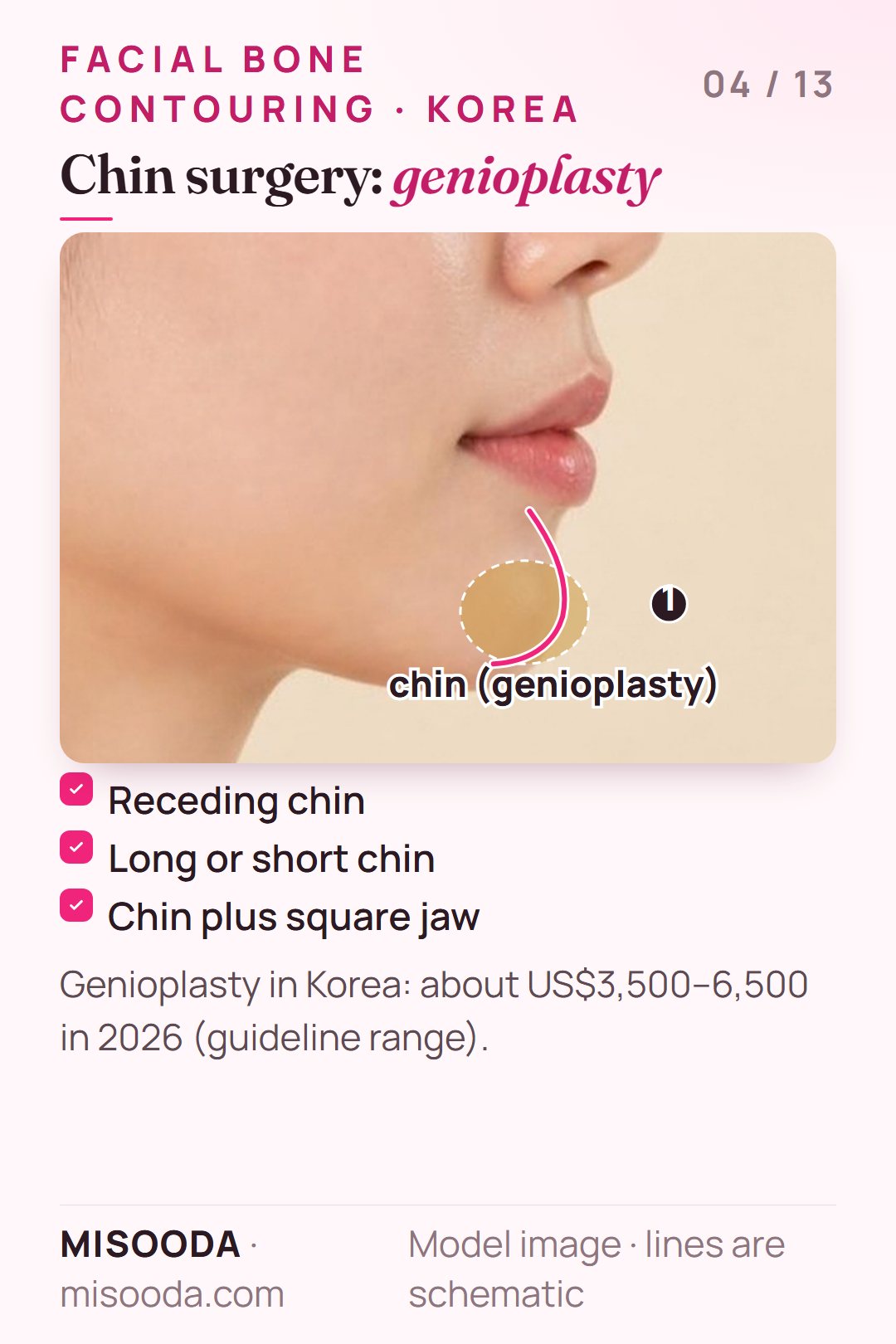 Genioplasty chin reshaping zone on a side profile for a receding, long or short chin — about US$3,500–6,500 in Korea in 2026