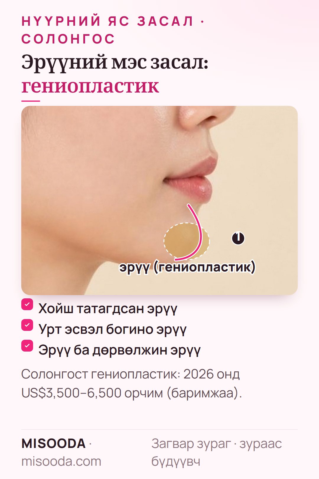 Хажуу төрхөөр гениопластик буюу эрүү засах бүс — хойш татагдсан, урт эсвэл богино эрүүнд, Солонгост 2026 онд US$3,500–6,500 орчим
