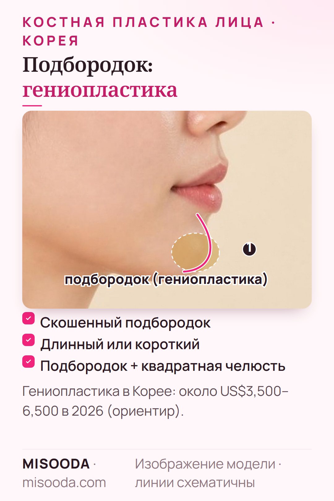 Зона гениопластики подбородка в профиль при скошенном, длинном или коротком подбородке — около US$3,500–6,500 в Корее в 2026 году