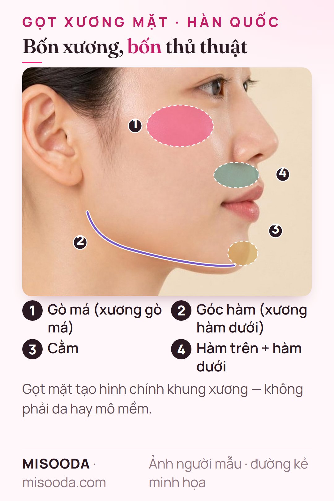 Các vùng gọt xương mặt Hàn Quốc trên góc nghiêng: gọt gò má, góc hàm cho V-line, tạo hình cằm genioplasty và hàm trên, hàm dưới cho phẫu thuật hai hàm