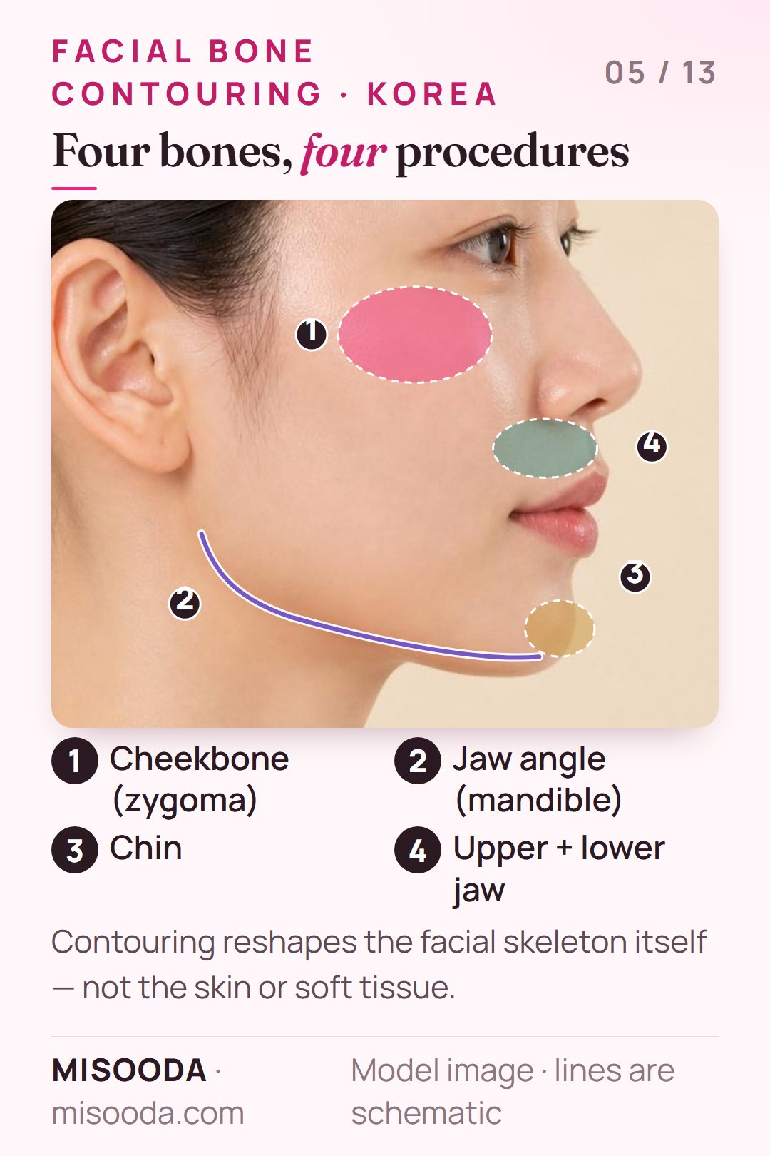 Facial bone contouring zones on a side profile: cheekbone (zygoma) reduction, jaw angle for V-line, chin genioplasty and upper and lower jaw for two-jaw surgery