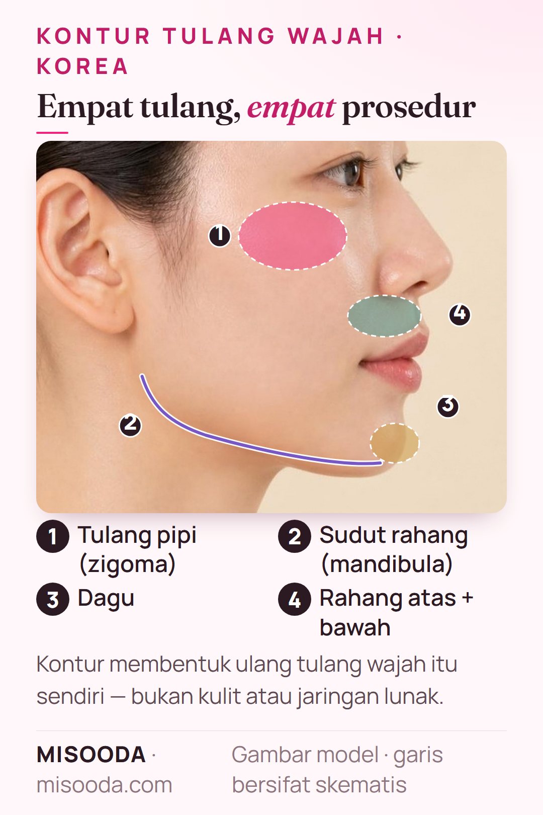 Zona kontur tulang wajah di Korea pada profil samping: reduksi tulang pipi (zigoma), sudut rahang untuk V-line, genioplasti dagu, rahang atas dan bawah untuk operasi dua rahang