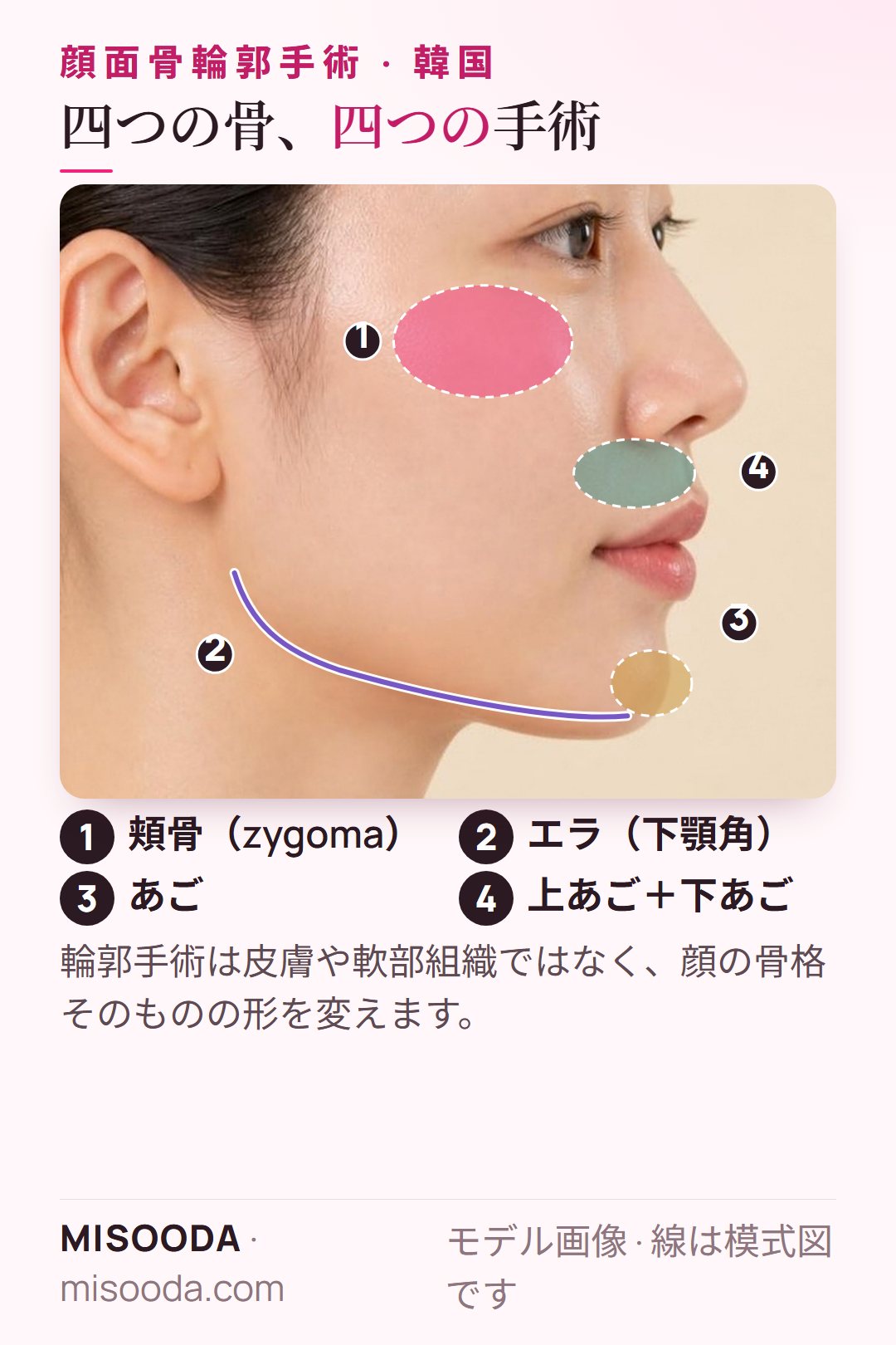 韓国 顔面骨輪郭手術の部位を横顔で図示:頬骨(zygoma)縮小術、Vラインのエラ、あごのオトガイ形成術、両顎手術の上下のあご