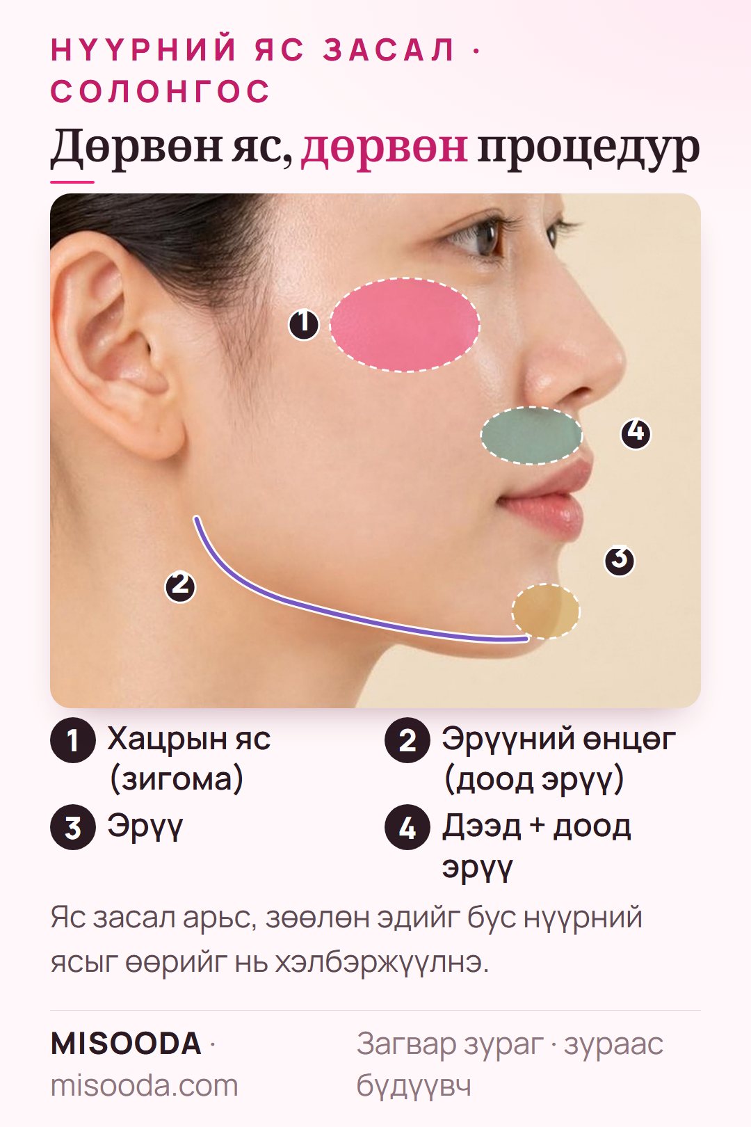 Нүүрний яс заслын бүсүүд: хацрын яс (зигома) багасгах, V-line-ийн эрүүний өнцөг, гениопластик, хоёр эрүүний мэс заслын дээд ба доод эрүү